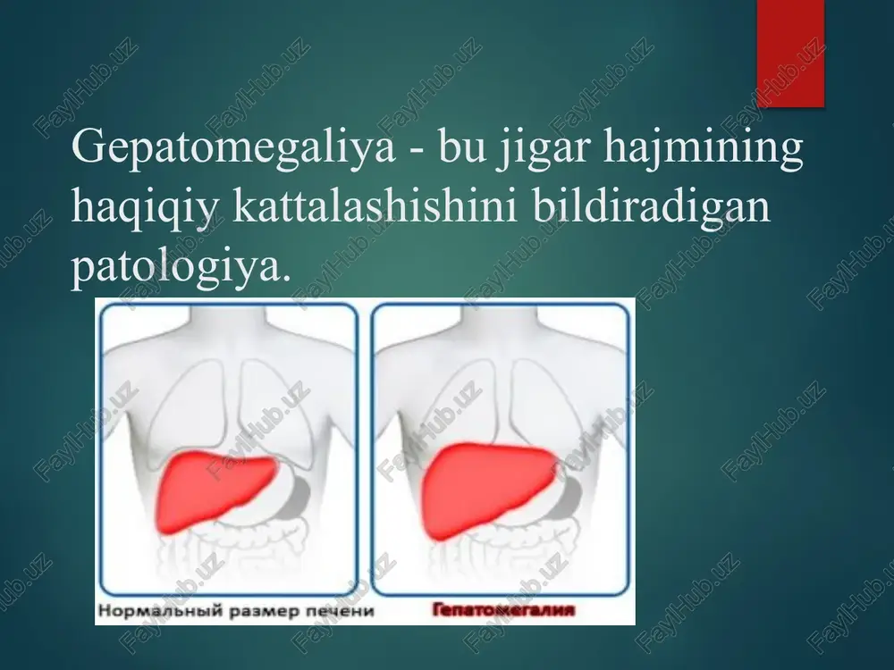 'simta mavjudligini ko'rsatadi; palpatsiya paytida og'riq yallig'lanishni (gepatit) yoki organ hajmining tez o'sishini ko'rsatadi (o'ng yurak etishmovchiligi , badd - chiari kasalligi sindromi ), yog 'infiltratsiyasi). gepatomegaliyaning • qon tomirlari tiqilishi: o'ng yurak etishmovchiligi (jumladan, 3 tabaqali klapanning shikastlanishi), badd-chiari kasalligi •infiltratsion jarayonlar: yog‘ning to‘planishi (“yog‘li” jigar, masalan, etanol, qandli diabet, ortiqcha parenteral oziqlanish, homiladorlik), limfoma yoki leykemiya, ekstramedullar gematopoez, amiloidoz, granulomatoz gepatit (sil, atipik virus , mikobakoz , , gemokromatoz , gaucher kasalligi, glikogenoz •yallig‘lanish kasalliklari: virusli yoki dorivor gepatit, sirroz •o'smalar : birlamchi karsinoma, metastatik saraton, fokal nodulyar giperplaziya, jigar adenomasi •kistalar : polikistoz • jigar kasalliklari. masalan, lizosomal kislota lipaza etishmovchiligi bilan bemorlarning 87 foizida gepatomegaliya kuzatiladi. gemokromatoz bu temirning to'planishi kasalligi bo'lib, unda ichakda haddan tashqari ko'paygan so'rilish uning to'qimalarda to'planishiga olib keladi, keyinchalik organlarning, ayniqsa jigar, oshqozon osti bezi , yurak va gipofiz bezining shikastlanishi va funktsional etishmovchiligi. makroskopik jihatdan jigar kattalashgan (og'irligi 3000 grammga …