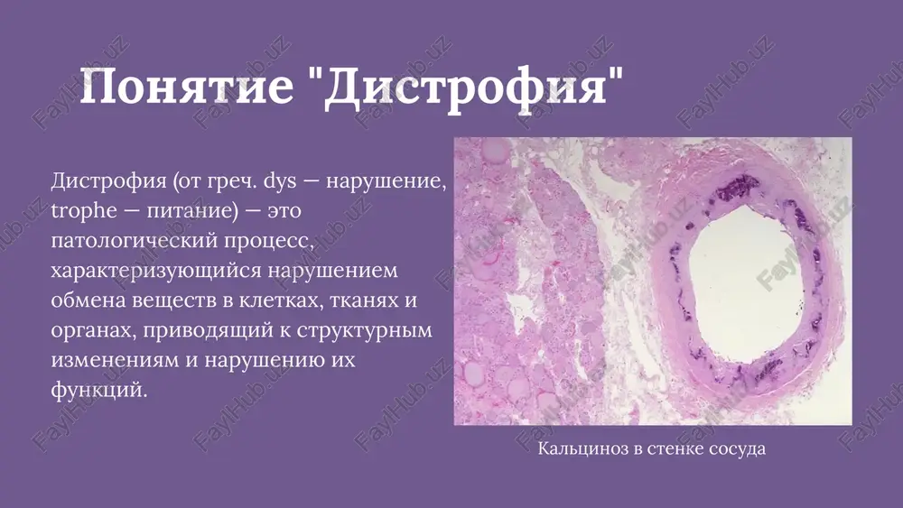 soley kaltsiya i ix otlojenie v etu zonu. naprimer, pri tuberkuleze legkix v zonu kazeoznogo nekroza proisxodit otlojenie so- ley kaltsiya, inkapsulyatsiya (obrazovanie kapsuli vokrug ochaga). voz- mojno obrazovanie kostnoy tkani. eto pozvolyaet soxranyat nesteril- niy immunitet. drugoy primer — otlojenie soley kaliya v atero- skleroticheskie blyashki, v kotorix imeyutsya distroficheskie i nekro- ticheskie izmeneniya. metasgaticheskoe obizvestvlenie kaltsiy vsasivaetsya v oblasti nachalnix otdelov tonkoy kishki, a videlyaetsya pochkami i chastichno tolstoy kishkoy. pri xronicheskix zabolevaniyax pochek, tolstogo kishechnika, peredo- zirovki vitamina d, opuxolyax parashitovidnoy jelezi s izbitochnim videleniem paratgormona, povishaetsya uroven kaltsiya v plazme krovi (giperkaltsiemiya) i voznikaet ochagovoe otlojenie soley kaltsiya v raznix organax i tkanyax. izvsstkovie metastazi miokarle: soli kaltsiya (sk) fiksi- rovani na kristax mitoxondriy (m). elektronogramma, x40 000 distroficheskoe obizvestvlenie stenki arterii. v tolshe ateroskleroti- cheskoy blyashki vidni otlojeniya izvesti (ukazano strelkami) umenshenie kolichestva kaltsiya v organizme raxit — xronicheskoe zabolevanie, xarakterizuyusheesya narusheniem fosforno-kaltsievogo obmena so …