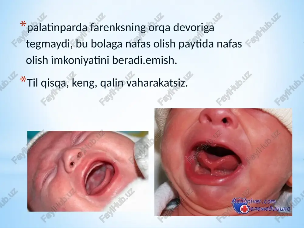 n siyraklashtirilganbo'shliq bo'shlig'iog'iz ona sutini oladi. inchaqaloq emishiritmik hosil qiladipastki jagning olddan orqaga harakatlari. qizilo'ngach kirishqizilo'ngachgan/r joylashganorasidagi disk darajasidaiiivaivservikal vertebra va yosh bilan asta-sekinkamayadi. uzunlikqizilo'ngach yoshi bilan o'sib boradi. yosh bolalarda qizilo'ngach nisbatan bo'ladiqisqa. anatomik siqilishlarn/r vahayotning birinchi yilidagi bolalar nisbatan zaif ifodalangan. o'tishbolalikning barcha davrlarida oshqozonga qizilo'ngach darajasida joylashganx-xiko'krak umurtqalari. qizilo'ngach devorin/ryupqa, mushak pardasi kam rivojlangan. tug'ilgandan keyin shilliq qavatning epiteliysi tez qalinlashadi.shilliq qavatchaqaloqlarda qizilo'ngach bezlarda kambag'aldir. oshqozon oshqozon n/r quyidagilarga ega: kichik quvvat nisbatan funktsional etuklik silindr, buqa shoxi yoki ilgak shakli balandda joylashgan va bolaning o'sishi va rivojlanishi bilan u tushadi chaqaloqlarda oshqozon gorizontal holatda joylashgan oshqozonning yurak qismi, fundus va pilorik qismin/rzaif ifodalangan, darvozabonkeng kiritishoshqozonning bir qismi ko'pincha yuqorida joylashgandiafragma vanayozishni qaytarishga to'sqinlik qiladigan gubareva, deyarli yo'qifodalanganyurak sfinkteri funktsional jihatdan pastroq, oshqozonning pilorik qismi esa tug'ilish paytidayoq funktsional jihatdan yaxshi rivojlangan.bularxususiyatlar oshqozon tarkibini qizilo'ngachga qaytarish ehtimolini keltirib chiqaradi bundan tashqaribundan tashqari, hayotning birinchi yilidagi bolalarning regürjitatsiya …