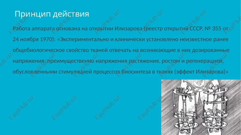 koltsa sterjni ustanavlivayutsya parallelno drug drugu. repozitsiya oblomkov kostey proizvoditsya zatyagivaniem gaek i kontrgaek. vsled za nalojeniem apparata osushestvlyaetsya kontrolnaya rentgenografiya, pozvolyayushaya korrigirovat polojenie oblomkov. stabilnost fiksatsii podderjivaetsya ravnomernim podvinchivaniem gaek na ¼ oborota kajdogo sterjnya do 2 mm kajdie 5–7 dney udlinenie konechnostey i illyustratsii dlya udlineniya konechnosti, naprimer goleni, neobxodimo proizvesti osteotomiyu bolshoy i maloy bertsovix kostey, a takje udlinenie axillova suxojiliya i drugix suxojiliy mishts goleni. rastyajenie proizvoditsya na 7–12-y den posle operatsii na 0,25–1 mm ejednevno. posle udlineniya konechnosti na nujnuyu velichinu eyo fiksiruyut v tom je apparate dlya konsolidatsii (priblizitelno na 3 mesyatsa ot momenta operatsii)[2]. protsedura lecheniya otkritogo pereloma bolshoy i maloy bertsovoy kostey apparatom ilizarova. fotografii i rentgenogrammi odnogo i togo je patsienta v techenie kursa lecheniya. snimki 2 — 6 sdelani cherez chetire nedeli posle pereloma (dve nedeli posle nalojeniya apparata) image1.jpeg image2.jpeg image3.jpeg image4.jpeg image5.jpeg image6.jpeg image7.jpeg image8.jpeg