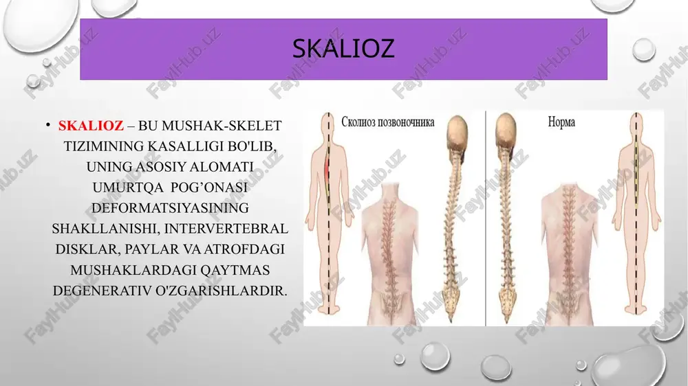 im manbalarda raxitiik skaliozni idiopatik skaliozga qo’shiladi. m.v.volkov, e. k. nikiforova va a.f.kaptelin bo’yicha klassifikatsiya skalioz tug’ma orttirilgan skolioz displastik skolioz raxitdan keying skolioz statik skolioz idiopatik skolioz skalioz sabablari: tug`ma sabablar quyidagilardir: umurtqa pog`onasining chala rivojlanganligi; shakllangan g'ayritabiiy qo'shimcha umurtqalar; homila rivojlanishi davrida endokrin tizimning buzilishi. orttirilgan sabablarga esa quyidagilar kiradi: umurtqa pog'onasining shikastlanishlari; bo`yin umurtqasida suyak chiqishi; tananing uzoq vaqt davomida noqulay va notabiiy holatda bo`lishi; mushak massasining assimetrik rivojlanishi; noto`g`ri yoki zaiflashgan umumiy jismoniy rivojlanish. bolalarda ushbu kasallik ko`pincha tananing ayrim qismlarining notabiiy holati va haddan tashqari bosim tufayli yuzaga keladi. skalioz darajalari kasallikning belgilari odatda uning darajasi bilan belgilanadi: i darajali skolioz - bemorning yelkalari, tos suyagi joylashuvining o`zgarishi, boshini pastga egilishi, bukchayish; ii darajali skolioz — umurtqa pog'onasining qiyshiq joylashuvi bemor tanasining har qanday holatida ko'rinadi, bo'yin konturlari va bel uchburchagi assimetrik holatda; iii darajali skolioz – qovurg`a bukrisi hosil bo`ladi, qovurg`alarning o`zi bo`rtib chiqadi, …