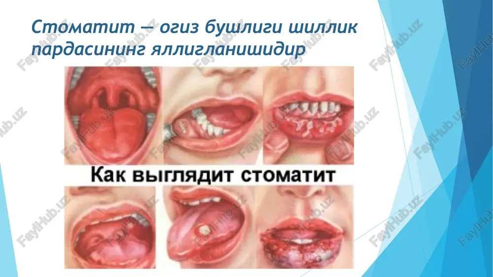 uzatiladi. surunkali gastritni tasnifi 1.etiologiyasi va patogenezi bo‘yicha: gastritni a,v va s turlari ajratiladi. 2.topografiyasi bo‘yicha: antral, fundal, gastrit va pangastrit formalari kuzatiladi. 3.morfologik o‘zgarishlari bo‘yicha: yuzaki (atrofik bo‘lmagan) va atrofik gastrit yara kasalligi surunkali kasallik bo‘lib, morfologik substrati oshqozonda va 12 barmoqli ichakda surunkali retsidivlanuvchi yara bo‘lishi bilan xarakterlanadi piloroduoldenal yaralarni patogenezi. adashgan nervni gipertonusi, peptik omilni faolligini oshadi oshqozonni va 12 barmoq ichakni motorikasini buzilishi ro‘y beradi aktg va glyukorkortikoidlarni miqdori ko‘payadi. oshqozon tanaqismidagi yarasini patogenezi. gipotalamo – gipofiraz sistemasini funksiyasi pasayadi adashgan nervni va oshqozon sekretsiyasini tonusini kamayishiga olib keladi. shilliq qavatni ximoya omillari kuchsiz-lanadi. surunkali yara a) eroziya bosqichi – bu yuzaki defekt shilliq qavatini nekrozi. b) o‘tkir yara bosichi – ancha chuqur defekt oshqozonni devorida xamma qavatlari shikastlanadi. noto‘g‘ri shakilli dumaloq yoki oval yara chetlari yumshoq bo‘ladi yara kasalliklarini asoratlari yarali – destruktivli yarani perforatsiyasi (teshilishi) yara penetratsiyasi yaradan qon ketishi yallig‘lanishli gastrit, perigastrit, duotsenit, …