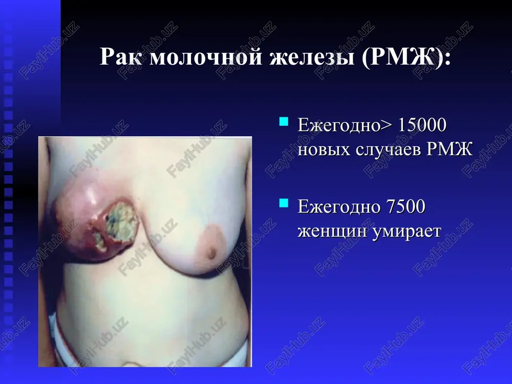 utriprotokovaya papilloma (bolezn mintsa) d) kista patogeneticheskie formi rmj gipotireoidnaya forma - 5% yaichnikovaya forma - 40-50% gipertenzivno-nadpochechnikovaya forma - 40% involyutivnimi (starcheskaya) forma - 5-10% rak beremennix (pozdnie beremennosti) klinicheskie formi rmz nachalnaya forma (opuxol do 1 sm v diametre) uzlovaya forma diffuznaya forma: a) otechno-infiltrativnaya; b) pantsirnaya; v) mastitopodobnaya; g) rojistopodobnaya 4. rak pedjeta po gistologicheskoy klassifikatsii raka molochnoy jelezi, prinyato voz (1969), razlichayut: 1. vnutriprotokovaya i vnutrishnodolkova ne infiltriruyushie kartsinoma. 2. infiltriruyushie kartsinoma 1, 2 i 3 stepeni zlokachestvennosti: invazivnie adenokartsinomi, skirrozniy, solidnie, smeshannie, nizkodifferentsirovannie formi. 3. osobie gistologicheskie varianti kartsinomi: medullyarniy rak; papillyarniy rak; fibrozniy rak, (reshetchatiy) rak; slizistiy rak; ploskokletochniy rak; rak pedjeta. rak molochnoy jelezi rak soska i areoli rak molochnoy jelezi mastitopodobniy forma rak molochnoy jelezi mastitopodobniy forma rak molochnoy jelezi rak molochnoy jelezi rak soska i areoli rak molochnoy jelezi s prorastaniem v koju i raspadom rak molochnoy jelezi rak molochnoy jelezi …
