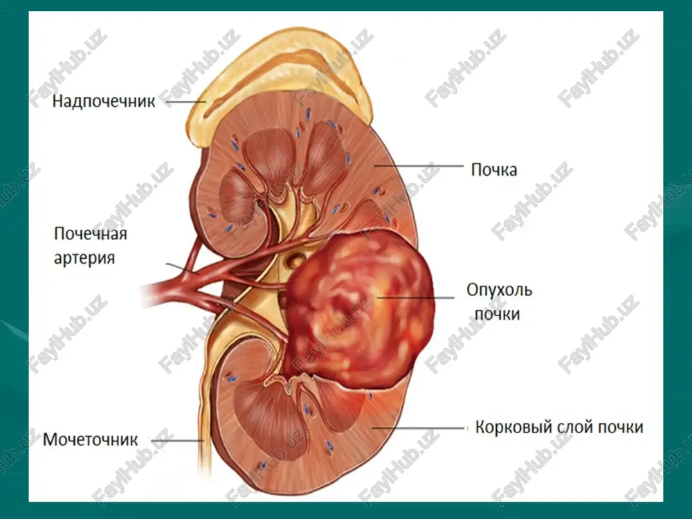 a mexanizmini ishga tushiradi,hatto bu mexanizm to'qima oksigenatsiyasi normada bo'lganda g'am ishlayveradi.natijada o'sishning ko'plab anomal faktorlarini giperproduktsiyasi sodir bo'ladi,bular angiogenezni kuchayishiga olib keladi. patomorfologiya buyrakning xavfli o'smalarining zamonaviy tasnifi morfologik, tsitogenetik va molekulyar tekshiruvlar asosida qo'yilib quyidagi 5 turi farqlanadi: yorug' hujayrali rak - 60-70 %; papillyar rak - 7-14 %; yassi hujayrali rak- 4-10 %; onkotsitar rak - 2-5 %; yigma yo'lakchalar (protok) raki - 1-2 %. buyrak raki gematogen va limfogen yo'llar bilan metastazlanadi. limfogen metastazlar asosan parakaval va paraaortal limfa tugunlariga beriladi.uzoq a'zolarga –o'pka,umurtqa pog'onasi,yassi suyaklar,jigar,buyrak usti bezi,bosh miyaga beriladi. 1.buyrakning yorug' hujayrali raki. 2. buyrakning papilyar raki 3. buyrakning yassi hujayrali (xromofob) raki – strelka bilan ko'rsatilgan. t-birlamchi o'sma tx-birlamchi o'smani baholash imkoni yo'q t0-birlamchi o'sma aniqlanmaydi. t1-o'sma o'lchami 7 smgacha buyrak chegarasidan chiqmagan t1a- o'sma o'lchami 4 smgacha; t1b-o'sma o'lchami 4 smdan 7 smgacha t2-o'sma o'lchami 7 smdan katta buyrakdan chiqmagan. t2a-o'sma o'lchami 7 smdan …