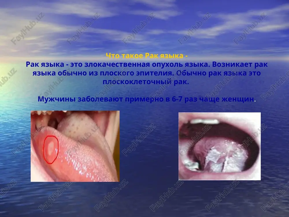 stoyashaya iz sosochkovix razrastaniy soedinitelnoy tkani, snaruji pokritix mnogosloynim ploskim epiteliem. papillomi imeyut belesovatuyu okrasku ili tsvet slizistoy obolochki. imeet tonkuyu nojku ili shirokoe osnovanie. razmeri papillom koleblyutsya ot 2 mm do 2 sm. papillomi bivayut myagkie i tverdie. prostaya (xronicheskaya) yazva i eroziya voznikayut v rezultate xronicheskogo razdrajeniya ploximi protezami. rombovidniy glossit - vospalitelniy protsess na spinke yazika v vide romba. dlya zabolevaniya xarakterno xronicheskoe techenie (v techenie neskolkix let). bolnie jaluyutsya na bol v yazike, slyunotechenie. pri palpatsii otmechaetsya uplotnenie yazika. patogenez formi rosta i puti metastazirovaniya. stadii videlyut 3 anatomicheskie formi raka organov polosti rta: yazvennaya; infiltrativnaya; papillyarnaya. pri yazvennoy forme opredelyaetsya yazva s nerovnimi, krovotochashimi krayami. pri infiltrativnoy forme otmechaetsya silniy bolevoy sindrom, palpiruetsya plotniy infiltrat, bez chetkix granits, bugristiy. nad infiltratom otmechaetsya istonchenie slizistoy. papillyarnaya forma predstavlena opuxolyu, vistupayushey nad poverxnostyu slizistoy. otlichaetsya bolee medlennim rostom po sravneniyu s dvumya drugimi formami. bolshinstvo rakovix opuxoley …