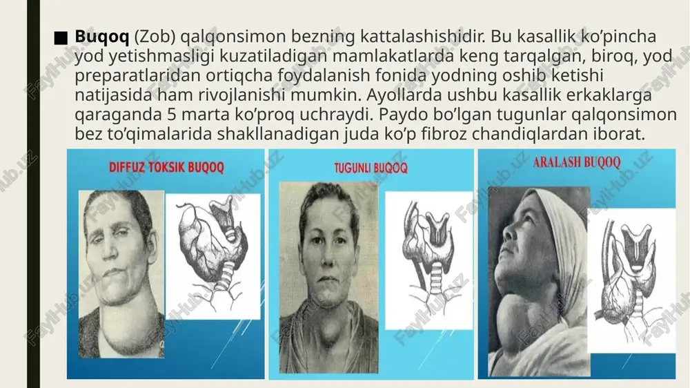 utoimmun kasalliklarga ko’proq moyil bo’lib qolishadi. ushbu antitanalar qalqonsimon bez faoliyatini ham sustlashtiradi. natijada zaiflik, xotiraning pasayishi, shishlar, tana vaznining ortishi, terining quruqlashishi, sochlarning mo’rtligi, mushak og’riqlari va spazmlar, ich qotishlari kuzatiladi. etiologiya ushbu kasallikning dunyo bo’ylab eng keng tarqalgan shakli endemik buqoq hisoblanadi. bunga yod tanqisligi sabab bo’ladi. yodlangan tuz ishlatiladigan mamlakatlarda odatda xasimoto buqoqi shakllanadi, uning muqobil nomi autoimmun tireoidit. boshqa sabablarni ikkita shartli guruhga bo’lish mumkin: 1. gipotireoz: endokrin bezi gormonlarini qayta ishlashining genetik kasalliklari (masalan, kretinizm); strumogenik mahsulotlarni iste’mol qilish; dori vositasidan foydalanilgandan keyingi nojo’ya ta’sirlar gipotireozning alomatlari — soch to’kilishi, terining quruq va oqimtir bo’lishi, tirnoqlarning mo’rtligi, qoshlarning ingichkalashi, ishtahani buzilishi, vazn ortishi. qalqonsimon bez kasalliklarida nutq sekinlashadi, xotira yomonlashadi, deyarli doimiy uyquchanlik mavjud, hayz sikli buziladi. bunday holatda, ushbu barcha belgilar mavjud bo’lishi kuzatilmasligi mumkin, 2-3 ta belgilar mavjud, biroq ular yanada aniqroq seziladi. 2. gipertireoz: greyvs kasalligi deb ataladigan diffuz (tarqoq) tipdagi toksik …