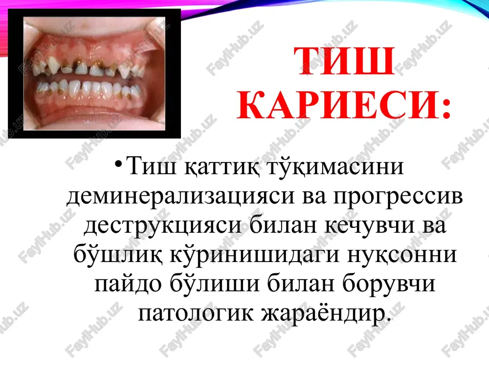 ri; tish qattiq to'qimalarini rezistentligi; tish qattiq to'qimalarining noto'liq strukturasi; tish pulpasining xolati; tish-jag' tizimini shakllanish davridagi, doimiy tishlarni yorib chiqish davridagi xoladi. tish kariesining ko'p omilli modeli inson: emal kristallari strukturasi, minerallari; so'lak xajmi va sifati; immuniteti; odatlari mikroorganizmlar: s.mutans, lactobacilli va boshqa bakteriyalar atrof muhit: tish karashini miqdori va sifati, fermentlar va minerallar, bakteriyalar, ximoya omillar, madaniyat. karies kasalligini keltirib chiqaruvchi birlamchi omillar: tish to'qimasini kariesga moyilligi; tish pilakchasi; kariesogen omillar bilan doimiy aloqa. tish pilakchasi yopishqoq strukturali bo'lib, bakterial xujayra va xujayralararo modda (matritsa)dan iborat. milk usti karashlar – karies chaqiruvchi omil; milk osti karashlar – parodont kasalligini chaqiruvchi omil. tish karashining rivojlanish fazalari: 18 1-faza: (1-2 kun) milk bilan chegaralangan tish yuzasi bakteriyalar bilan qoplanadi. ular mavjud bakteriyalarga yopishadi 2-faza: (3-4 kun) karashning yuza qavati gr+ tayoqchalar qavati bilan qoplanadi va qalinlashadi 3-faza: (4-7 kun) karash milk ostiga o'tib, bakteriya va ularning metabolitlari milk egatiga tsirkulyatsiyalanadi. …