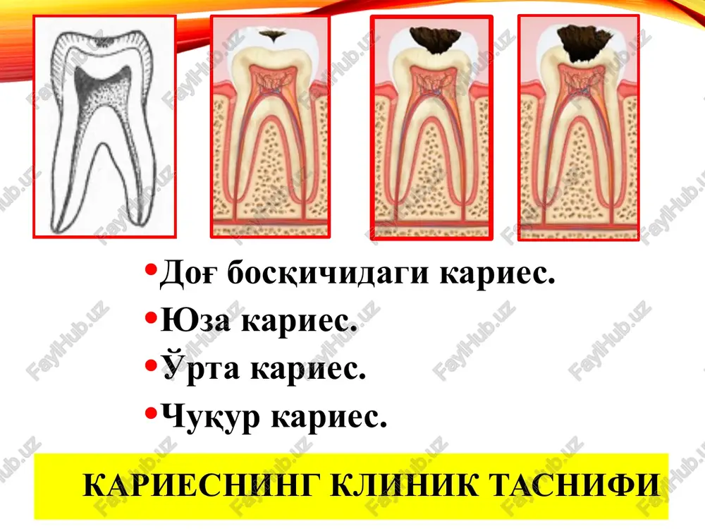 an soxalarni ftor saqlovchi vositalar bilan ishlov berishni taklif etgan. minimal invaziv davolash (mit — minimal intervention treatment) tishning anatomik va funktsional butunligini maksimal saqlash bilan kariesni erta davolash usuli. shundan kelib chiqqan xolda stomatolog uchun erta minimal invaziv aralashuvni qo'llash imkonini beruvchi mount tasnifi yaratiladi. karioz kavakni charxlash variantlari: 1— minimal invaziv texnika; 2— blek bo'yicha klassik texnika. karioz zararlanishlarning tasnifi (mount, 1997) lokalizatsiyasi zararlanish xajmi 0 1 2 3 4 1 (okklyuzion yuza) 1,0 1,1 1,2 1,3 4,1 2 (kontakt yuza) 2,0 2,1 2,2 2,3 4,2 3 (bo'yin oldi zona) 3,0 3,1 3,2 3,3 4,3 karioz zararlanishning klinik ifodasi quyidagicha kodlanadi: – 0— bo'shliqsiz karioz zararlanish; – 1— kichik bo'shliqli karioz zararlanish; – 2— o'rta xajmdagi bo'shliqli karioz zararlanish; – 3— katta xajmdagi bo'shliqli karioz zararlanish; – 4— kesuv qirra va do'mboqlarni yo'qotilishi bilan kechuvchi karioz zararlanish. tashxis ikkita son bilan ifodalanadi: 1-zazarlangan tish yuzasi, 2-karioz zararlanishning klinik …