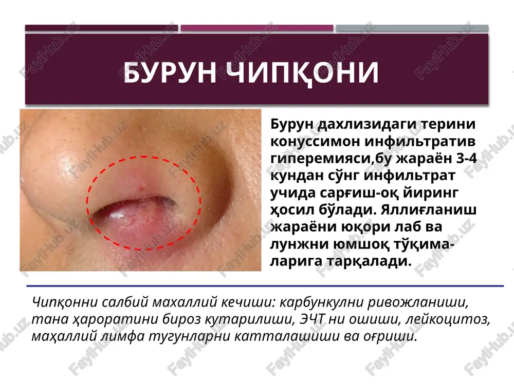 o3 eritmasi, 3% uchxloruksus kislota eritmasi); burun qonashining tuxtatish printsiplari qisman qonashda – old tamponada; kuchli qonashda – orqa tamponada, tashki uyqu arteriyasi boglash; medikamentoz tadbirlar – qon ivishini oshiruvchi vositalar, qon quyish, oksigenoterapiya; burunning oldingi tamponadasi oldingi tamponadada turunda burun tubidan boshlab burun daxlizidan to xoanagacha tartibli ustma ust terib chiqi-ladi. tizzasimon pintset yoki gartmanning burun qisqichi bi-lan turunda oxiridan 6-7 sm qoldirib ushlab olinadi va burun tubi satxi bo'ylab xoana-gacha kiritiladi,pintsept chiqa-rib olinadi va yana turundasiz kiritilib qo'yilgan turunda ustidan bosib turunda burun tubiga maxkamlanadi va shu tariqa keyingi turundalar kiritiladi. burun orqa tamponadasining bosqichlari kateterni burun tubi bo'ylab burun xalqumgacha kiritish va distal oxirini og'iz orqali chiqarib olish kateterning distal oxiriga tamponni maxkamlash burun orqa tamponadasining bosqichlari tamponni xoanagacha olib borish va barmoq bilan ushlab turish tamponni burunning oldingi qismiga maxkamlash otogen miya ichi asoratlari subdural abstsess ekstradural abstsess miya abstsessi perisinuoz abstsess sigmasimon sinus trombozi miyacha …