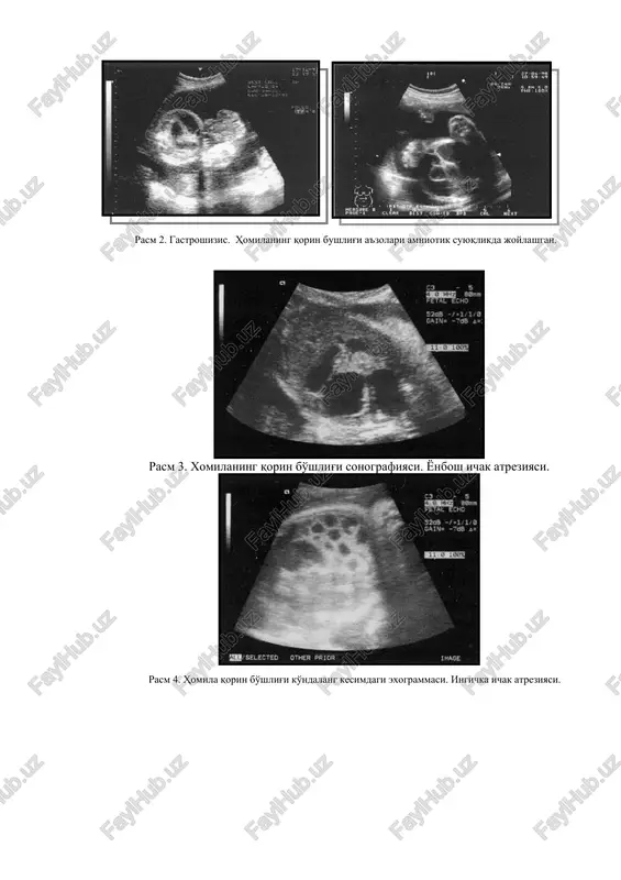ostik aniqlik bilan ko'plab skrining tekshiruvlar olib borish mumkinligi tufayli keng ko'lamda foydalanilmoqda. ( rasm 1 . yuqori ichak tutilishi antenatal diagnostikasi. 12 barmoqli ichak atreziyasi ) ( rasm 2 . gastroshizis. homilaning qorin bushlig'i a'zolari amniotik suyuqlikda joylashgan. ) rasm 3. xomilaning qorin bo'shlig'i sonografiyasi. yonbosh ichak atreziyasi. ( rasm 4. homila qorin bo'shlig'i ko'ndalang kesimdagi exogrammasi. ingichka ichak atreziyasi. ) rasm. 5. anus atreziyasida yo'g'on ichak distal bo'limlarining kengayishi. rasm 6. homila exogrammasi. pastki ichak tutilishi, peritonit belgilari bilan. yumshoq to'qimalar va suyaklarning yiringli yallig'lanish kasalliklarida, exinokokkoz kasalligida keltirib chiqaruvchi etiologik omillarni diagnostikada va identifikatsiyasida immunologik tekshiruvlar, bu kasalliklar differentsial diagnostikasida yangi mezonlarni paydo bo'lishi va va yyaklarida etiotrop va patogenetik asoslangan davo samaradorligini oshishiga olib keldi. oxirgi o'n yilliklarda tibbiyotdagi eng katta yutuq deb, tug'ma nuqsonlarning bola tug'ilishigacha bo'lgan davrdagi diagnostikasi (antenatal) deb hisoblash mumkin. hozirgi davrda tug'ma nuqsonlarning ko'p qismini bola tug'ilguncha aniqlash mumkin. prenatal diagnostika …