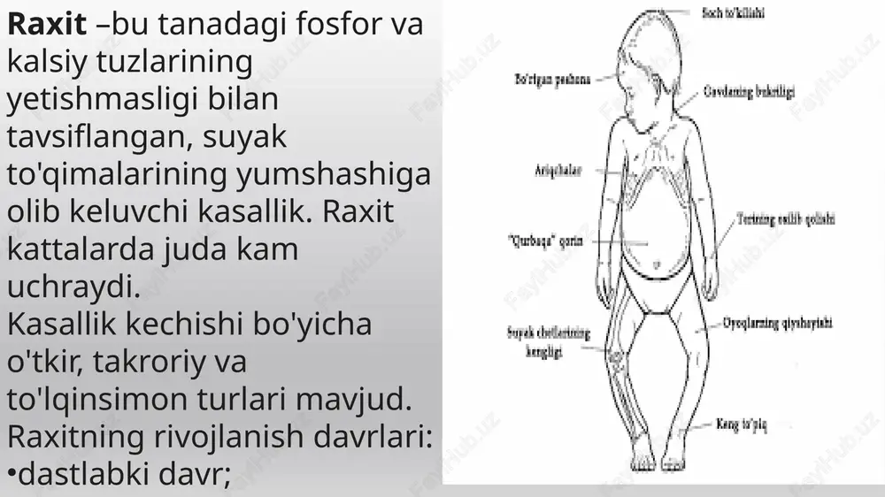 o'limga olib kelmaydi, ammo bir qator asoratlarni keltirib chiqaradi, masalan: suyak tizimining to'liq buzilishi; aqliy va jismoniy rivojlanishni sekinlashishi; jag' tuzilishining buzilishi; anemiya; immunitetning pasayishi. xavf guruhi ortiqcha yoki juda oz vazn bilan tug'ilgan bolalar; harakatlanish faoliyati kam bo'lgan bolalar; jigar, o't yo'llarining surunkali kasalliklari bor bolalar. oldini olish bolalarda raxitning oldini olish uchun quyidagilar tavsiya etiladi: terapevtik mashqlar; massaj; toza havoda ko'proq sayr qilish; balansli parhez. parhez bemorning ratsioniga quyidagi ovqatlar kiritiladi: sut, tvorog, sariyog; yog'li dengiz baliqlari; treska jigari; tuxum sarig’i; meva va sabzavot sharbatlari, damlamalar, pyurelar. organizmda d vitamini yetishmasligi tufayli fosfor-kalsiy almashinuvining buzilishi natijasida kelib chiqadi. raxitga koʻpincha bolaning chala tugʻilishi, quvvatsizligi, sunʼiy ovqatlantirish sabab boʻladi. bola yaxshi parvarish qilinmasa, ochiq havo va quyosh nuridan bahramand boʻlmasa, notoʻgʻri ovqatlantirilsa, uning organizmiga d vitamini yetarli miqdorda kirmaydi yoki ultrabinafsha nurlar yetishmasligidan terisida d vitamini hosil boʻlishi buzilib, raxit kasalligi kuchayadi. bundan tashqari, bolaning tez-tez kasallanishi, onaning homiladorlik …