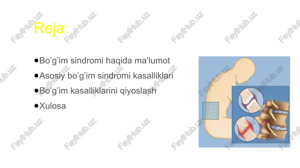 ofitlar, bo‘g‘im bo‘shlig‘i torayishi. ko‘proq keksalarda uchraydi. podagra artriti purin almashinuvi buzilishi → siydik kislotasi↑. ko‘proq erkaklarda uchraydi. klinik belgilari: keskin boshlanadi, kechasi kuchli og‘riq odatda bitta bo‘g‘im (ko‘pincha oyoq bosh barmog‘i) shish, qizarish, issiqlik surunkali shaklida tofuslar (mk kristallari) asorat: podagrik nefropatiya, buyrak toshlari. yuqumli artrit (sepsis, bakterial, virusli, qo‘ziqorinli) infeksiya natijasida bo‘g‘imda yallig‘lanish. klinik belgilari: keskin og‘riq, qizarish, shish isitma, intoksikatsiya bo‘g‘im harakati keskin cheklangan laboratoriya: qonda leykositoz, crb↑; bo‘g‘im suyuqligida mikroblar aniqlanadi. davolash: antibiotiklar, yiring bo‘lsa – drenaj. 5 qiyosiy jadval ko‘rsatkichlar revmatik artrit osteoartroz podagra artriti yuqumli artrit boshlanishi sekin-asta sekin-asta to‘satdan, kechasi keskin, infeksiya fonida shikastlanish turi simmetrik, ko‘p bo‘g‘im katta bo‘g‘imlar, assimetrik odatda bitta bo‘g‘im bitta yoki bir nechta og‘riq xususiyati ertalab kuchli, qotishish bilan harakatda kuchayadi juda kuchli, to‘satdan doimiy, infeksiya bilan bog‘liq qo‘shimcha belgilar revmatik tugunlar osteofit, deformatsiya tofuslar, buyrak zararlanishi isitma, intoksikatsiya laborator ko‘rsatkich rf+, anti-ccp+, soe↑ o‘zgarish yo‘q mk↑ qonda …