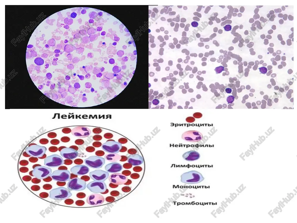 (yoki leykemiya turlari) asosan kasallikning kechishiga (o‘tkir yoki surunkali) va zararlangan hujayra turiga (limfoid yoki miyeloid) qarab 4 ta asosiy guruhga bo‘linadi: o‘tkir limfoblastik leykoz (all) bu tur limfotsitlar (oq qon hujayralarining limfoid liniyasi) yetilmagan ― “blast” holatidagi hujayralar orqali rivojlanadi. masalan, tasvirlarda hujayralar kattaroq, yadrosi keng va sitoplazmasi kamroq bo‘lgan shaklda ko‘rinadi. aksariyat hollarda bolalarda uchraydi. diagnostikada qon va suyak iligi namunalari muhim rol o‘ynaydi. 2. o‘tkir miyeloblastik leykoz (aml) bu tur miyeloid liniyadagi hujayralar – ya’ni qizil qon hujayralari, trombositlar va ba’zi oq qon hujayralar poydevori hujayralaridan kelib chiqadi. hujayralar yetilmay, nazoratsiz ko‘payadi. tasvirlarda “auer novdalari” (auer rods) ham ko‘rinishi mumkin. kattaroq yoshdagi bemorlarda nisbatan ko‘p uchraydi va tez rivojlanadi. 3. surunkali limfotsitik leykoz (cll) bu tur b‑limfotsitlar (ba’zan t‑limfotsitlar) dan kelib chiqadi va odatda sekin kechadi. qon da ko‘plab kichik limfotsitlar ko‘rinishi mumkin, ba’zan “smudge cells” (ezilib qolgan hujayra izlari) ham kuzatiladi. ko‘pincha simptomlarsiz kechishi mumkin va …