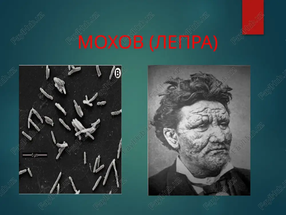 a moxov mikobakteriyalari topilmasa, shifokor kasallikning klinik belgilariga ko'ra tashhis qo'yadi. ammo, laboratoriya tekshiruvi orqali qo'yilgan tashhis aniq va ishonarliroq bo'ladi. moxovning lepromatoz xilida kasallikning boshqa xillariga nisbatan mikobakteriyalar ko'proq topiladi. yuqori nafas yo'llari, masalan, burun shilliq qavatidan olingan surtmalardan preparat tayyorlanadi. buning uchun burun bo'shlig'i yaxshilab tozalanadi, buni bemorning o'zi qilsa ham bo'ladi. so'ngra avvaldan tayyorlab qo'yilgan doka tampon o'ralgan tayoqchalar bilan burunning ichki devoridan surtmalar olinadi va bir nechta buyum oynasiga bir xil qalinlikda surtiladi. moxov mikobakteriyalarini topishda zararlangan teri to'qimasining suyuqligidan tayyorlangan surtmalarni tekshirish yaxshi natija beradi. dastlab shu soha terisi spirt yoki efir bilan tozalanadi, yaxshilab artiladi, bunda birinchidan aseptikaga rioya qilinsa, ikkinchidan kislotaga chidamli ba'zi saprofit mikroorganizmlar mikobakteriyalardantozalanadi. so'ngra mo'ljallangan teri sathini qo'l barmoqlari bilan qisib turib, steril o'tkir jarrohlik pichog'i (skalpel) bilan 5 mm uzunlikda va 2–3 mm chuqurlikda tilinadi. ajralgan suyuqlikni skalpelda qirib olib, buyum oynasida bir nechta surtma tayyorlanadi. to'qima suyuqligi qosh, …