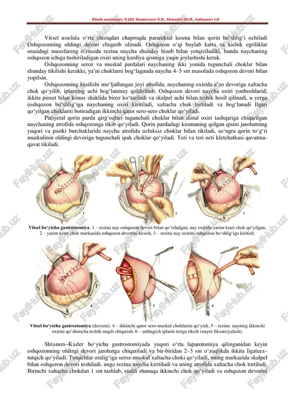 ari basov, vitsel, toprover, shtamm – kader, yuxtin va boshqalar tomonidan ishlab chiqilgan. klinik anatomiya. ii jild. shomirzaev n.h., ahmedov sh.m., gulmanov i.d. vitsel usulida o‘rta chiziqdan chaproqda pararektal kesma bilan qorin bo‘shlig‘i ochiladi oshqozonning oldingi devori chiqarib olinadi. oshqozon o‘qi buylab katta va kichik egriliklar orasidagi masofaning o‘rtasida rezina naycha shunday hisob bilan yotqiziladiki, bunda naychaning oshqozon ichiga tushiriladigan oxiri uning kardiya qismiga yaqin joylashishi kerak. oshqozonning seroz va muskul pardalari naychaning ikki yonida tugunchali choklar bilan shunday tikilishi kerakki, ya’ni choklarni bog‘laganda naycha 4–5 sm masofada oshqozon devori bilan yopilsin. oshqozonning kesilishi mo‘ljallangan joyi atrofida, naychaning oxirida a’zo devoriga xaltacha chok qo‘yilib, iplarning uchi bog‘lanmay qoldiriladi. oshqozon devori naycha oxiri yonboshlarid; ikkita pinset bilan konus shaklida biroz ko‘tariladi va skalpel uchi bilan teshik hosil qilinadi, u yerga (oshqozon bo‘shlig‘iga naychaning oxiri kiritiladi, xaltacha chok tortiladi va bog‘lanadi ilgari qo‘yilgan choklarni botiradigan ikkinchi qator sero-sero choklar qo‘yiladi. pariyetal qorin …