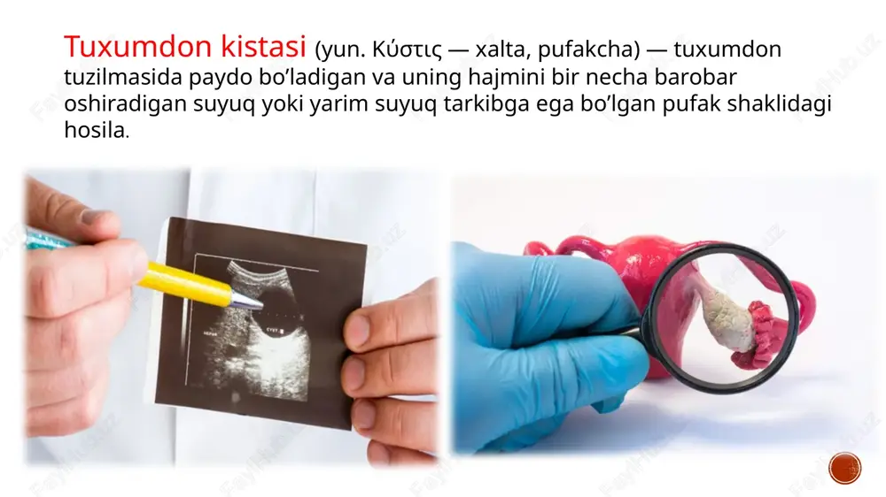 ora) bo‘shliq ko‘rinadi, ichida hech qanday tuzilmalar yo‘q. endometrioid kistalar (endometriomalar) tuxumdon endometriozi tufayli paydo bo’ladi. endometrioz o’chog’idan har oyda kichik qon ketishlar tuxumdonda qon bilan to’lgan bo’shliq paydo bo’lishiga olib keladi. uning ichidagi qon vaqt o’tishi bilan quyuqlashadi, qorayadi va tuzilishi va rangiga ko’ra suyuq shokoladga o’xshash bo’ladi. shuning uchun bunday kistalar «shokoladli» deb ham ataladi. kistoz o’smalar haqiqiy o’simtalarga oid sanaladi, ammo ularda kistaning tashqi belgilari ham mavjud. kista va kistoz o’smalarni ba’zan faqatgina gistologik tekshiruvdan keyin ajratish mumkin. kistoz o’smalar seroz va mutsinoz sistadenomalarni, shuningdek yetuk teratomalarni (dermoid kistalarni) o’z ichiga oladi. prichini vozniknoveniya endometrioidnoy kisti yaichnika zabolevaniya endokrinnogo xaraktera; postoyannie stressi i perejivaniya; izbitok ili nedostatok vesa; ginekologicheskie vospalitelnie protsessi; sostoyaniya immunodefitsita; xirurgicheskie vmeshatelstva na organax malogo taza; slojnie rodi; prichini dermoidnoy kisti yaichnika gormonalnie rasstroystva vo vremya beremennosti; priem teratogennix farmakologicheskix sredstv; vrednie privichki; nutritivniy defitsit; tyajelie stressovie situatsii; infektsionnie zabolevaniya, v osobennosti virusnie. endodermoidnaya …