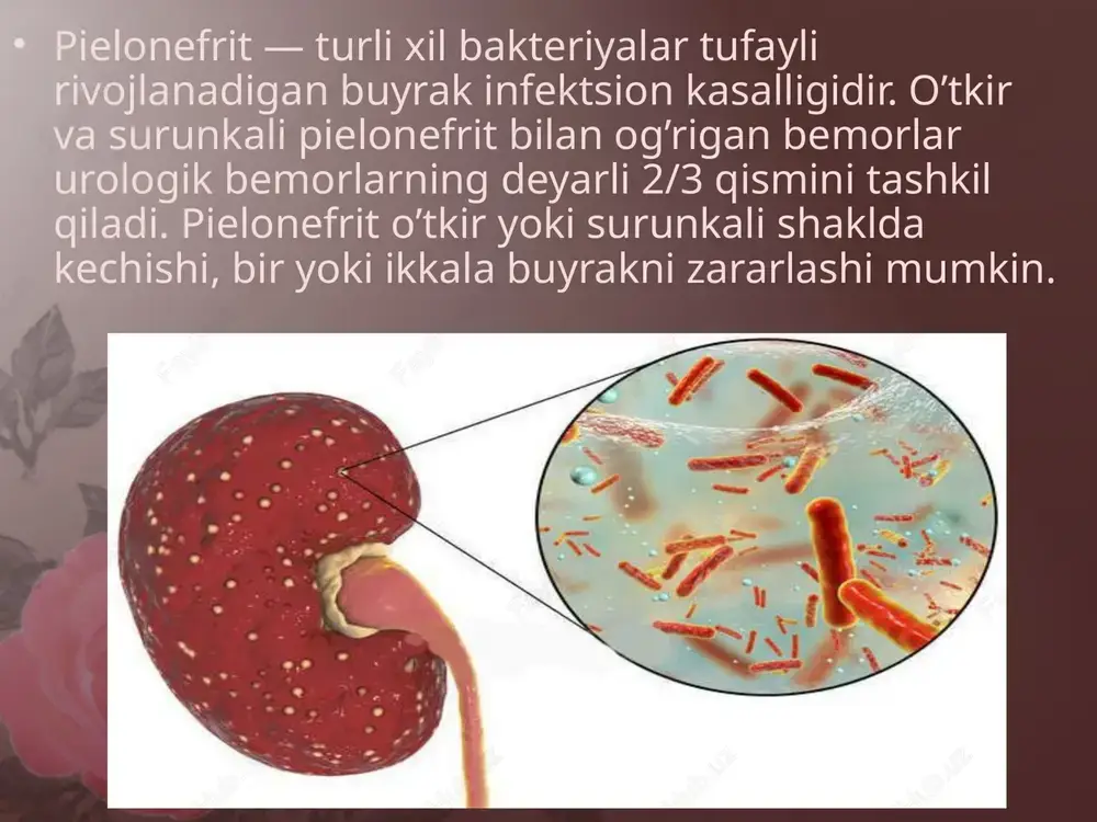 rator siydik tahlilida bakteriuriya, biroz proteinuriya va mikrogematuriya aniqlanadi. umumiy qon tahlili leykositoz va echt oshganini ko’rsatadi. taxminan 30% hollarda qonning biokimyoviy tahlili natijasida azotli shlaklarning ortganligi aniqlanadi. surunkali pielonefrit ko’pincha davolanmagan o’tkir shakldagi kasallikning oqibatidir. shuningdek bemor anamnezida o’tkir pielonefrit bo’lmay turib, birdan birlamchi surunkali pielonefrit rivojlanishi mumkin. ba’zan surunkali pielonefrit siydik tahlillari natijasida tasodifan aniqlanadi. surunkali pielonefrit bilan og’rigan bemorlar ko’pincha zaiflik, ishtahaning pasayishi, bosh og’rig’i va tez-tez siydik chiqarishdan shikoyat qiladi. ba’zi bemorlarni sovuq, nam havoda kuchayadigan bel atrofidagi to’mtoq og’riq bezovta qiladi. ikki tomonlama surunkali pielonefritning rivojlanib borishi bilan buyrak faoliyati buziladi, bu esa siydik solishtirma og’irligining ortishiga, gipertoniya va buyrak yetishmovchiligiga olib keladi. surunkali pielonefritning o’tkirlashganini ko’rsatuvchi belgilari o’tkir shakldagi kasallik klinik tasvirlari bilan mos. ikki tomonlama o’tkir pielonefrit o’tkir buyrak yetishmovchiligiga olib kelishi mumkin. eng og’ir asoratlarga sepsis va bakterial shokni misol qilsa bo’ladi. ba’zi hollarda o’tkir pielonefrit paranefrit kabi asoratga olib kelishi mumkin. …