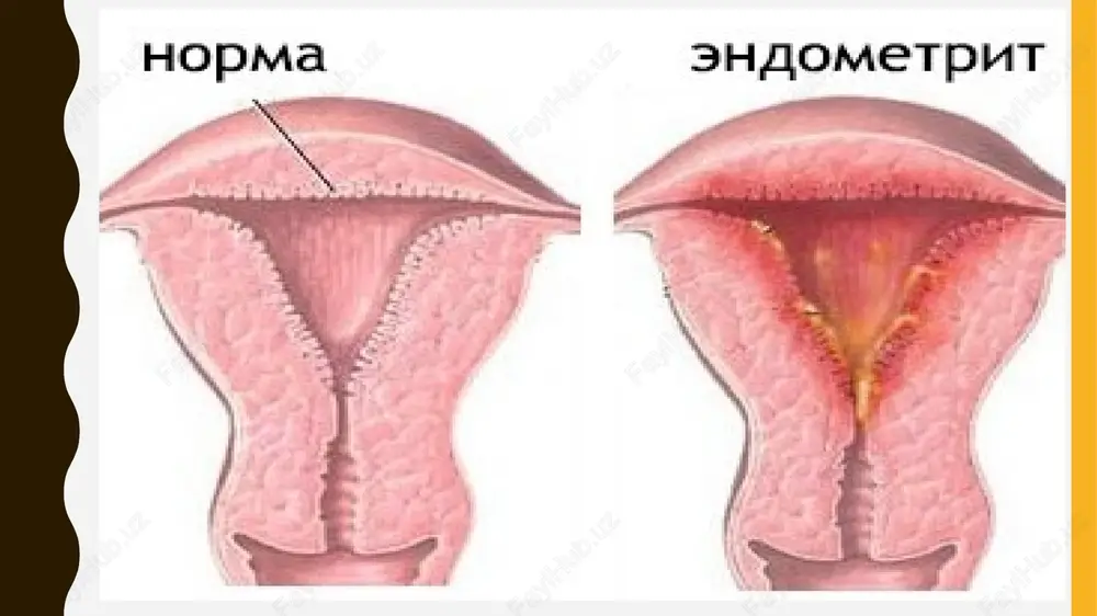 etsifik kolit yoki enterit, homiladorlik, laktatsiya davrida qo'llash mumkin emas. antibiotiklar: amoksatsilin tseftriakson tsefozalin klindamitsin gentamitsin doksitsiklin asoratlar: -salpingoofit -menstrual tsiklning buzilishi -limfadenit -sepsis -spaykalar paydo bulishi -bepushtltik profilaktikasi -shaxsiy gigienaga rioya kilish -infektsion yalliglanish kasalliklarini vaktida davolash -bachadon ichi manipulyatsiyalaridan sung antibiotik profilaktika kabul kilish image1.png image2.jpeg image3.png image4.png image5.png image6.png image7.png image8.jpeg image9.jpeg image10.jpeg image11.jpeg