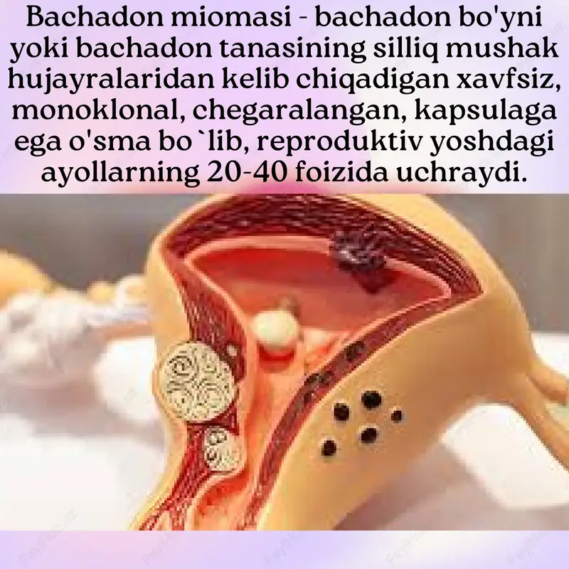 ronn ing m iqdor i e s t rogen kab i , rep rodukt i v yoshda s i k l i k rav i shda o ' zgarad i , homi lador l i k payt ida sez i la r l i da ra jada oshad i va menopauzadan key in kamayad i . shunday q i l ib , k l i n i k va laborato r i ya tadq iqot la r i shun i ko ' r sa tad ik i , ham es t rogen , ham proges te ron m ioma o ' s i sh in i rag 'bat lant i rad i . klassifikatsiyasi: submukoz mioma subseroz mioma i n te r s t i t s ia l m ioma hayz s ik l i davomiy l ig in ing uzay i sh i , ko`p miqdorda qon ke …