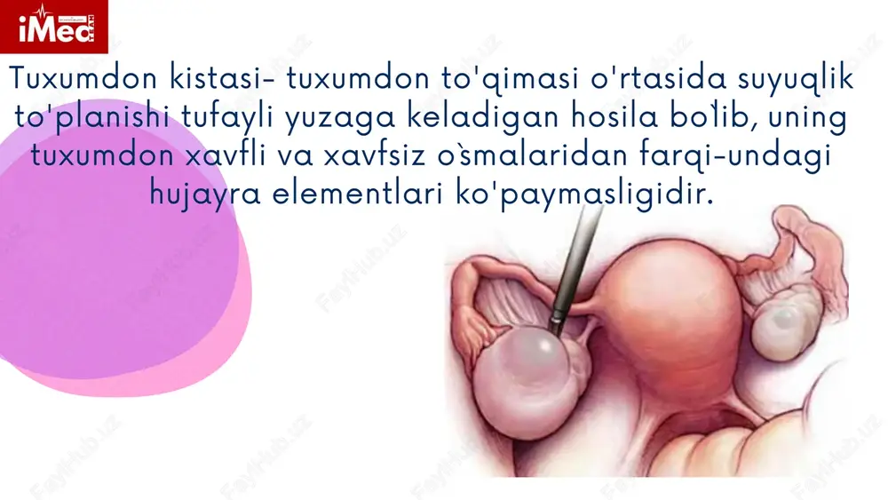 hida shaffof limon-sariq suyuqlik tutadi. kista qorin bo'shlig'iga qarab o'sadi. follikular kistalar klinik jihatdan kista estrogenlarning yuqori ishlab chiqarilishi natijasida bachadondan qon ketishi sifatida namoyon bo'lishi mumkin, bu esa bachadon shilliq qavatida giperplastik jarayonlarga, qorinning pastki qismida yengil tortish og'rig'iga va kista oyog'i buralib qolganda qattiq og'riqqa olib keladi. asoratlanmagan kichik follikulyar kista odatda asimptomatik bo'lib, ginekologik tekshiruv vaqtida aniqlanadi. klinikasi: tashxislash asosan utt ga asoslanadi davolash: follikulyar kistani davolash tuxumdonlarning gonadotropik stimulyatsiyasini tormozlovchi kombinirlangan oral kontraseptivlarni qo`llash orqali bo`ladi. davolash davrida ultratovush tekshiruvi yordamida kista o`lchamlari kuzatilib boriladi. jarrohlik yo'li bilan olib tashlash uch oy konservativ davolanish davomida kista hajmining kichrayishi kuzatilmasa hamda ortiqcha estrogenizatsiya belgilari kuchaysa ko`rsatma bo`ladi. sariq tana kistalar hayzning 2- siklida hosil bo`lgan sariq tananing atreziyaga uchramay suyuqlik to`plashi natijasida hosil bo`ladi. uning yuzaga kelishida ko`p miqdorda gonadotrop gormonlar ishlab chiqarilishi, ba`zan ko`p miqdordagi prolactin sintezi sabab bo`ladi. sariq tana kistalar teka hujayralari bilan chegaralangan …