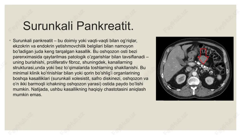 a’zida oshqozon osti bezi boshidagi sklerotik jarayonlar o’t yo’llari va oshqozon osti bezi kanalining siqilishiga o’xshash klinik ko’rinishga olib keladi. xuddi shunday ko’rinish oshqozon osti bezi boshining o’smalarida kuzatiladi, shuning uchun pankreatitning bu shakli psevdotumor deb ataladi. bunday hollarda safro chiqishi buzilishi obstruktiv sariqlikka olib kelishi mumkin. surunkali pankreatit fonida o’tkir pankreatit paydo bo’lishi mumkin, bu surunkali pankreatitning kuchayishi bilan teng emas. oshqozon-ichak traktining buzilishidan tashqari, surunkali pankreatit bilan og’rigan bemorlarda boshqa belgilar mavjud. 90% surunkali pankreatit bilan og’rigan bemorlarda mavjudligini tasdiqlovchi adabiy manbalar mavjud. polinevropatiyalar (periferik nervlarning funksional o’zgarishlari bilan bog’liq) holatlarining. diagnostika. surunkali pankreatitni tashxislash uchun standart tekshiruvdan tashqari, oshqozon osti bezining ekzokrin funksiyasi ham muhimdir. buni koprogram yordamida aniqlash mumkin (najasdagi hazm bo’lmagan oziq-ovqat qoldiqlarini mikroskopik tahlil qilish). instrumental tadqiqotlar ham qo’llaniladi: qorin bo’shlig’i organlarining ultratovush tekshiruvi, qorin bo’shlig’i organlarining kompyuter tomografiyasi va boshqalar. bemorlar chapqovurg’a osti sohasida zerikarli og’riqli og’riqlardan shikoyat qiladilar, ular boy va yog’li …