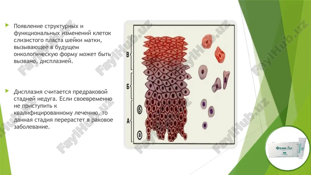 lesions) — lyogkaya displaziya, xarakternaya dlya patsientok s vpch. sootvetstvuet cin i; hsil – high grade squamous intraepithelial lesions) - otnositsya k obligatnomu predraku sheyki matki, to est sostoyaniyu epiteliya, kotoroe bez doljnogo lecheniya imeet visokiy shans transformatsii v zlokachestvennuyu opuxol. displaziya visokoy stepeni. sootvetstvuet cin ii i cin iii; cis — vnutriepitelialniy rak otdelnie tipi po sisteme betesda: asc-us atypical squamous cells of undetermined significance — prisutstvuyut atipichnie kletki, no po nim nelzya postavit diagnoz lsil (cin i); asc-h atypical squamous cells can not exclude hsil (atipichnie kletki ploskogo epiteliya, ne pozvolyayushie isklyuchit visokuyu stepen porajeniya).— variant mejdu asc-us i hsil. to est atipichnie kletki obnarujeni, no ne opoznani. odnako isklyuchit displaziyu visokoy stepeni (hisl) pri etom nelzya; ais — adenokartsinoma, zlokachestvennaya opuxol. atipichnie kletki ploskogo epiteliya podrazdeleni na dve podkategorii: neyasnogo znacheniya (asc-us: atypical squamous cells of undetermined significance (atipichnie kletki ploskogo epiteliya neyasnogo znacheniya); ne isklyuchayushie visokuyu …