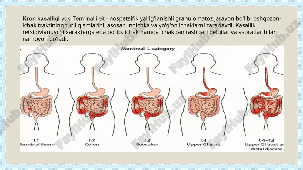 tsiyasida „qonli diareya“ kron kasalligiga xos belgi hisoblanadi. deyarli 2/3 qism kasallarda diagnoz bir yildan keyin aniqlanadi. kasallarning 1/3 qismida birlamchi diagnoz oshqozon-ichak tizimiga bogʻliq boʻlmagan tashxislar bilan davolanadi[2]. yarali kolitda kasallik kechishi qaytalanuvchi, zoʻrayish davri vaqtincha zaiflashish bilan almashib turuvchi xususiyatga ega boʻlsa, kron kasalligida doimiy boʻladi. kasallikning bolalarga xos shakli „ileokolit“ hisoblanadi (55 %). yoʻgʻon ichak (34 %) va ingichka ichak (10 %) shakllari kamroq uchraydi. ogʻiz boʻshligʻi shilliq pardasi biopsiya qilinganda, kron kasalligiga xos granulomalar aniqlanadi. baʼzida, kasallikning ogʻir shakllarida barmoqlarning „tugʻnogʻichsimon“ yoʻgʻonlashishi rivojlanadi. kron kasalligiga chalingan bolalar jismoniy rivojlanishdan orqada qoladi, ogʻirligi kam boʻladi. kasallikning ileosekal shaklida eng koʻp uchraydigan belgilardan biri, qorinning oʻng pastki toʻrtdan birida ogʻriq paydo boʻlishidir. kolorektal shaklida perianal yaralar, yoriqlar paydo boʻladi. ular, koʻpincha ogʻriqli va oqmalar, granulomatoz toʻqimadan iborat gʻadir-budir yuzalar hosil 152 qilib, oraliq sohasiga tarqalishi mumkin. baʼzida yaralarning jadal rivojlanishi natijasida, perianal soha muskullari ham jarohatlanishi mumkin. ingichka …