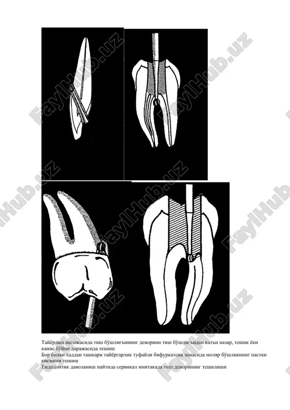 o'shlig'ining etarli darajada kengaymasligi yoki ish vaktining noto'g'ri belgilanishi bo'lishi mumkin. ildizlar tuzilishining anatomik xususiyatlari, shuningdek, kanalning asboblar uchun past darajadagi ishonchliligi omiliga aylanishi mumkin. ishlash texnikasini buzish, masalan, pulpa to'kimasini ekstraktor tomonidan neyrovaskulyar bog'ichning yorilishi bilan olib tashlash, ildiz pulpasining to'lik olib tashlanmasligi kanaldan kon ketishiga olib keladi, bu esa keyingi endodontik aralashuvni oldini oladi. kanalning lumenini dentin bilan to'ldirish sababi - kanalning lumeninde dentin filtrlarining to'planishi va ularning sikilishi. kanalni kayta o'tkazishga urinish, ildiz kanalini mexanik kayta ishlash maxsulotlarini (endo moylash materiallari, dentin filtrlari, pulpa koldiklari va boshkalar) apikal teshikdan tashkariga chikarishga olib kelishi mumkin, bu esa endodontik davolanishdan keyin og'rik keltirishi mumkin. bunday asoratning oldini olish uchun xar bir ikkinchi boskichdan keyin kanalni mayda asboblar bilan apikal torayishga o'tkazish va kanalning lumenini eritmalar bilan yuvish orkali amalga oshiriladi. obrazovanie apikalnogo ustupa ko'pincha bu kiyshik kanallarda sodir bo'ladi. kanalga ishlov berish jarayonida asbobning uchini burish paytida sirg'alib ketish …