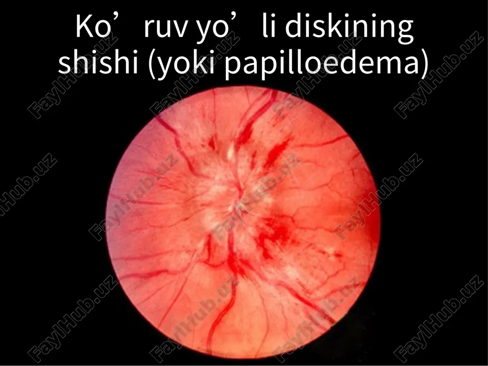 i; refleks na svet otsutstvuet ili vyaliy i sochetaetsya s cherveobraznim dvijeniem zrachkovogo kraya, (pri biomikroskopii); sodrujestvennaya reaktsiya otsutstvuet ili vyalaya; zrachok medlenno reagiruet na priblijenie, posleduyushee rasshirenie zamedlenno; akkomodatsiya mojet imet tonichnost; pri dlitelnom techenii zrachok mojet suzitsya (malenkiy stariy adie) farmakologicheskie testi: instillyatsiya 2,5% mexolila ili 0,125% pilokarpina – normalniy zrachok ne sujaetsya, porajenniy – sujaetsya (denervatsionnaya giperchuvstvitelnost). zrachok argyll robertson vizivaetsya neyrosifilisom i xarakterizuetsya sleduyushim: dvustoronnim porajeniem (assimetrichno); zrachki malenkie, nepravilnoy formi; zrachki ploxo rasshiryayutsya v temnote; pri otsutstvii rasprostranennoy atrofii radujki instillyatsiya atropina ili kokaina vizivayut midriaz. iii juft nervning zararlanishi qorachiqning efferent yo’llari buzilishi zararlangan tomonda svetga reaksiya yo’qoladi mojet nablyudatsya lojnaya dissotsiatsiya "svet — bliz" (psevdo-argayla robertsona) (reaktsiya na "bliz" , vyazana s napryajeniem vnutrenney pryamoy mishtsi) sindrom horner (okulosimpaticheskiy paralich) simptomlari: ptoz (umerenniy); mioz;s soxraneni refleksi na priblijenie i svet; gipoxrom geteroxromiya; umenshenie potootdeleniya s ipsilateralnoy storoni (porajenie nije verxnego sheynogo gangliya). sindrom …