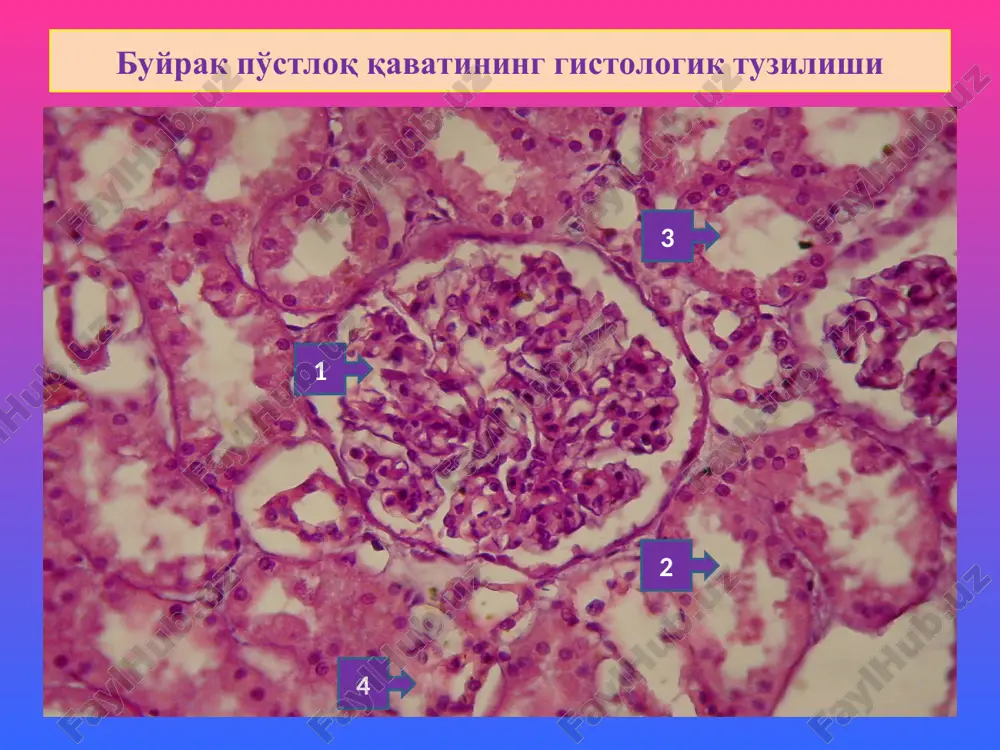erativ glomerulonefrit. bu - streptokokkli infektsiyadan keyin 4 xafta oralig'ida boshlanadi. ko'pincha 6-10 yoshli bolalar, ba'zida kattalarda uchraydi. klinik jihatdan o'tkir nefritik sindrom ko'rinishida kechadi. kasallik 1,5 dan 12 oygacha davom etadi va undan keyin cho'ziluvchi glomerulonefritga aylanadi. makro ko'rinishi. buyrak biroz kattalashgan, yumshagan, po'stloq qavati kengaygan, to'laqonli, tashqi pardasi ostida qon quyilishlar paydo bo'ladi “ola-bula buyrak” deyiladi. mikro- dastlab ekssudatsiya, keyin tez orada u prolifera-tsiyaga aylanadi va endoteliy, mezangiy hujayralari ko'payadi. buyrak stromasida mononuklear infiltratsiya, kanalchalar epiteliysida oqsilli distrofiya, bo'shlig'ida oqsilli va eritrotsitli tsilindlar paydo bo'ladi. immunoflyuorestsent mikroskopiyada mezangiy va gbmda igg, igm, s3 komplementdan depozitlar topiladi. elektron mikroskopiyada bazal membrananing epiteliy tomonida osmiofilli o'rkach ko'rinishidagi depozitlar aniqlanadi. o'tkir glomerulonefrit 1. koptokchada hujayralar proliferatsiyasi 2. kanalchalar epiteliysida oqsilli distrofiya 2 o'tkir glomerulonefrit tez avj oluvchi glomerulonefrit tez avj oluvchi glomerulonefrit (taog). (sinonimlari: xavfli nefrit, diffuz ekstrakapillyar proliferativ glomerul-rit) kasallik yosh va kattalarda, ayol va erkakda bir xil darajada uchraydi. …
