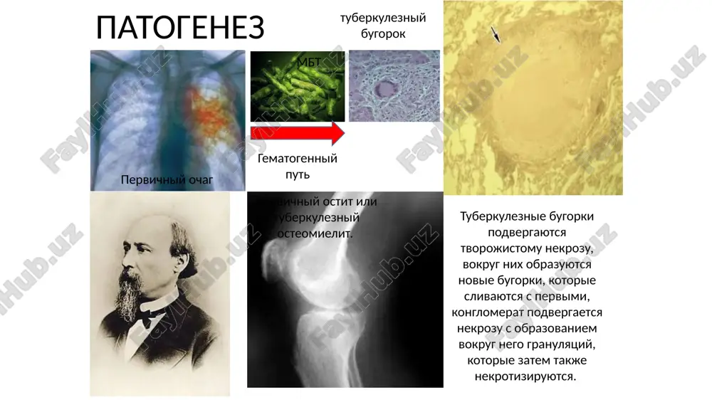 ial change. if in previous decennial events bone-joint tuberculosis mainly were ill the children, that at present disease most often are subjected to the people of the old age. moreover, beside elderly people in recently on share bone-joint tuberculosis happens to 72-75% all diseases of the tuberculous nature beside persons this age group suyak-bo'g'im sili asosan ko'krak va bel umurtqalarini zararlaydi. suyak-bo'g'im sili ichida sil spondiliti 40% ni tashkil qiladi. 20 % xollarda chanoq son bo'g'imi sili, 15% xollarda esa tizza bo'g'imi sili uchraydi. yassi suyaklar (qorvurg'alar, to'sh suyagi, kalla suyagi) sili, kaft va barmoq suklari sili, yelka va boldir panja bo'g'imi sili esa nisbatan kam uchraydi chashe vsego kostno-sustavnoy tuberkulyoz porajaet poyasnichnie i grudnie pozvonki. tuberkulyozniy spondilit, sostavlyaet 40% sluchaev vsex form kostno-sustavnogo tuberkulyoza. neredko vstrechaetsya tuberkulyoz tazobedrennogo (20%) i kolennogo (15%) sustavov. gorazdo reje viyavlyayut tuberkulyoz ploskix kostey (reber, grudini, kostey cherepa), zapyastnix kostey i falang, a takje …