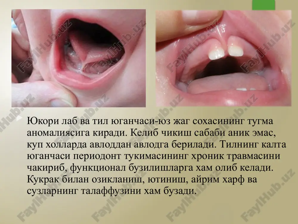 hi – logopedik (talaffuzning buzilganda logoped va jarroh hamkorligida hal qilinadi), maktab yoshidagi bolalarda ortopedik, ortodontik va parodontologik ko'rsatmalar (tegishli mutaxassis va jarrohlar ishtirokida hal qilinadi). chaqaloqlar va emizikli go'daklarda tilning kalta yuganchasini kesish operatsiyasining bosqichlari: -navbatdagi ovqatlantirish oldidan applikatsion og'riqsizlantirish o'tkaziladi. -tarnovchali zond yordamida til yuqoriga ko'tariladi. -so'lak naychalari chiqaruv teshigi usti sohasida yugancha tilga taqab kaychi bilan kesiladi. -kesilgandan so'ng romb shaklida yara ochiladi, yaraning ikki yoni kesib kengaytiriladi. odatda chok qo'yilmaydi. yugancha yupqa shilliq pardadan iborat bo'lganligi uchun kam qonaydi, yaraga antiseptiklar bilan ishlov berilib, bola onasiga emizish uchun beriladi (ovqatlantiriladi). til avvalgi o'rniga qayta bitib qolmasligi uchun yaraga yog' tomizib turiladi. chaqaloq va go'daklarda bu operatsiya yuganchani malum darajada uzaytiradi, ammo kattaroq yoshda uchburchak laxtaklar o'rnini almashtirish (plastik) usuli yordamida yugancha qayta uzaytiriladi. maktabgacha va maktab yoshidagi bolalarda til yuganchasini uzaytirishni bir nechta usullari bor. operatsiya maktabgacha yoshdagi bolalarda umumiy, katta bolalarda mahalliy og'riqsizlantirish ostida bajariladi …