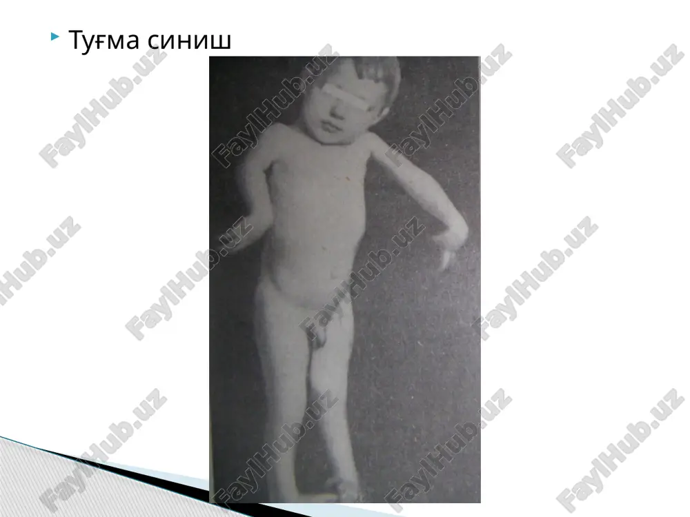 i. to‘g‘ri va bilib ko‘rsatilgan birinchi yordam, travmatik shokning profilaktikasi ham hisoblanadi. ochiq sinishlarda ketayotgan qon to'xtatiladi, jarohat atrofi ustidagi teri dezinfeksiya qilinib, bog‘lam qo‘yiladi. shina shikastlangan qo‘l-oyoqqa qo‘yiladi, buning uchun albatta yaqin oradagi ikkita bo'g'im fiksatsiya qilinishi lozim (elka va son suyaklari singanda uchta bo‘g‘im qotiriladi). birinchi yordam berishda singan joyni immobilizatsiya qilish uchun shina o'rnini qoplovchi materiallardan, masalan, karton, faner, taxtacha kabilardan foydalaniladi, harbiy-dala sharoitida yaralangan kishining shaxsiy qurolini ham ishlatsa bo'ladi (avtomat, karabin va b.). qisman fiksatsiyani bajarish uchun sog‘ qo‘l-oyoqlami ham ishlatsa bo‘ladi sinishni operativ davolash skeletni tortish usuli chiqishlar chiqish deb, bo'g'im yuzalarining siljib uzoq vaqt davomida nofiziologik bir-biriga nisbatan noto'g'ri turib qolishiga aytiladi. agar siljish natijasida bo'g'im yuzalari bir-biriga tegmay qolsa, to'ia chiqish, qisman tegib tursa, to ‘liq bo'lmagan chiqish deyiladi. chiqish atamasi fanda bo'g'imga kiruvchi distal suyak qismi bilan yuritiladi. masalan, yelka bo'g'imidan chiqsa, yelka chiqishi, tos-son bo'g'imining chiqishi yoki bo'g'im yuzasi kapsula …