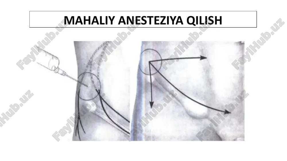 bo‘shlig‘iga kiritishda qiyinchilik yuzaga kelsa, yoki qorin parda bo‘shlig‘idagi patologik jarayonga (churra siqilishi, metastazlar va boshq.) shubha paydo bo‘lsa, churra xaltasini kesib ochish kerak. buning uchun churra xaltasi qisqichlarga olinadi, bo‘ylamasiga kesiladi va kesilgan chetlari to‘rtta qisqichlar bilan yon tomonlarga tortiladi. ichakning fiksatsiyalangan segmetlari, agar ular bitishmalar bilan yopishib ketmagan bo‘lsa, qaychilar bilan ajratiladi. ichak uzun masofada ajratilmasligi lozim, buning o‘rniga churra xaltasi yopilib, kiset chok yordamida tikliish kerak churra xaltasiga qiyin ajraladigan ichak segmentlari yopishgan to‘g‘ri chov churralari va sirpanuvchi churralar tashqi kiset chok yordamida tikiladi. kiset chok puxtalik bilan qo‘yilishi kerak (ichkaridagi tuzilmalarni shikastlab qo‘ymaslik maqsadida). to‘g‘ri chov churrasini ochishga ko‘rsatma yo‘q, odatda bunday churra xaltasi tashqi kiset chok yordamida to‘qimalarga tikiladi. churra xaltasi to‘g‘rilangandan so‘ng chok tortib bog‘lanadi va churra xaltasi fassiya sathidan pastga tushadi. shu ish davomida ko‘ndalang fassiyani kesish va qisqichlar bilan kengaytirish tavsiya etiladi. bu ko‘ndalang fassiyaning ichkariga kirib ketmasligini ta’minlaydigan va keyinchalik plastikada …
