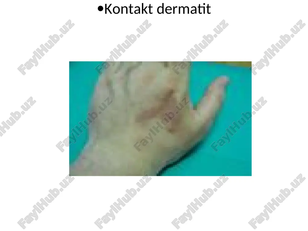 ha o’lim bilan tugaydi. gistolik: epidermisda nekrotik o’zgarishlar, akantoliz kuzatiladi va epidermis qavati ko’cha boshlaydi. epidermis ichi va ostida pufaklar paydo bo’ladi. donador va muguz qavatning bo’kishi, dermada limfostit, eozinofillar neytrofillardan iborat infiltrastiya kuzatiladi. toksidermiyalarda terida bo’ladigan o’zgarishlar qavarchiq-ko’p miqdordagi urtikar toshmalarning toshishi dogli-papulyoz toshmalarning kuzatilishi dorilarning fiksastiyalangan doglari lixenifikastiya ko’rinishida eritemalar purpuralar; qon quyilishlar pufak va pufakchalar. penistillin bilan davolangan bemorda kvinke shishi ampistillin bilan davolangan bemorda toshmalar nifedepin bilan davolangan bemorning oyoqlarida shish fenition chaqirgan allergik toshma fenolftalein qabul qilgandan keyingi fiksatsiyalangan toksidermiya tetrastiklin qabulidan keyingi fiksatsiyalangan toksidermiya fenilbutazondan keyingi fiksatsiyalangan toksidermiya stivens-djonson sindromi laella sindromi laella sindromi amiodaron qabulidan keyingi disxromiya monosiklindan keyingi disxromiya varfarinli nekroz geparindan keyingi nekroz pishgan teri sindromi xayz davrida ishlatilgan tampon natijasida kelib chiqgan toksik shok va teri o’zgarishlari medikamentoz toksikodermiya toksikodermiya toksidermiya toksikodermiya sulfanilamidli eritema ekzemaning eritematoz bosqichi medikamentoz toksikodermiya. eritematoz-skvamoz shakli. seboreyali dermatit seboreyali dermatit davolash usullari etiologik faktorning ta’sirini …