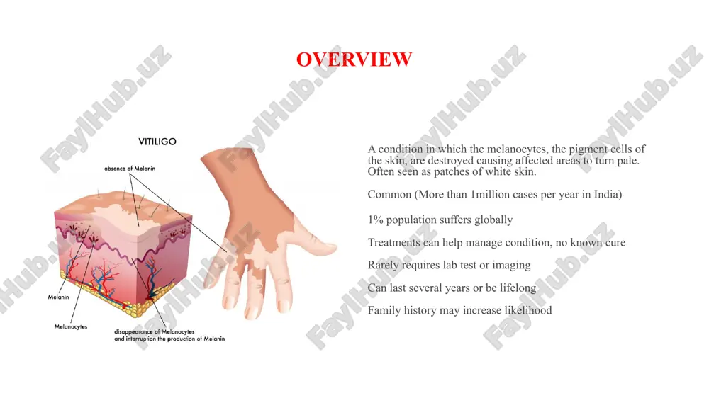 in the location of the patches of depigmentation. new patches also appear over time and can be generalized over large portions of the body or localized to a particular area. extreme cases of vitiligo, to the extent that little pigmented skin remains, are referred to as vitiligo universalis. nsv can come about at any age (unlike segmental vitiligo, which is far more prevalent in teenage years). classification of vitiligo classes of non-segmental vitiligo include the following: generalized vitiligo: the most common pattern, wide and randomly distributed areas of depigmentation universal vitiligo: depigmentation encompasses most of the body focal vitiligo: one or a few scattered macules in one area, most common in children acrofacial vitiligo: fingers and periorificial areas mucosal vitiligo: depigmentation of only the mucous membranes segmental segmental vitiligo (sv) differs in appearance, cause, and frequency of associated illnesses. its treatment is different from that of nsv. it tends to …