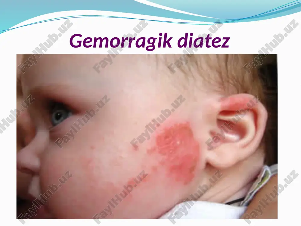 gemorragik diatezlar - Page 3