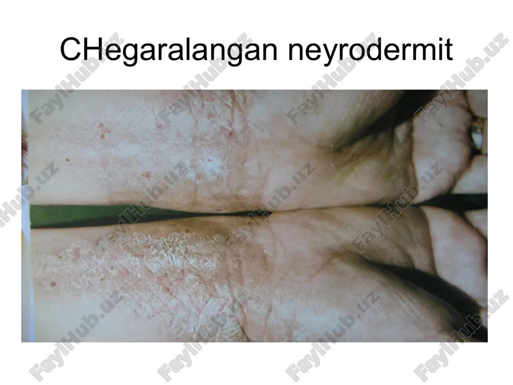 neyrodermatozlar tasnifi - Page 3