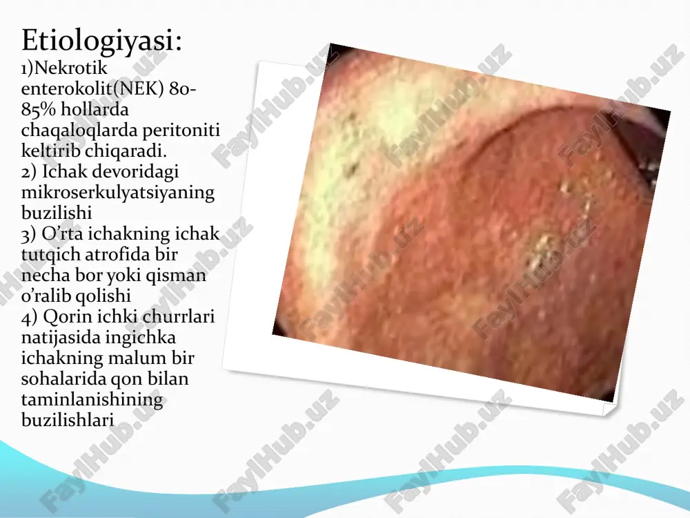 chaqaloqlarda peritonit - Page 3