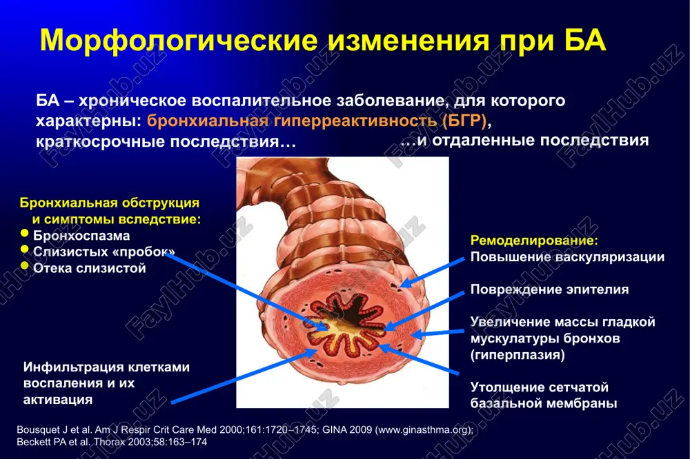 zvuk pri perkussii) pri obostrenii – uchastie v akte dixaniya vspomogatelnoy muskulaturi (mishts plechevogo poyasa), vtyajenie podatlivix uchastkov grudnoy kletki na vdoxe (osobenno u detey) taxipnoe, taxikardiyu gina 2009: www.ginasthma.org dlya diagnostiki ba naibolshee znachenie imeyut sleduyushie pokazateli: ofv1 – ob'em forsirovannogo vidoxa v pervuyu sekundu, fjel – forsirovannaya jiznennaya emkost legkix psv – pikovaya skorost vidoxa pokazateli giperreaktivnosti dixatelnix putey otsenka funktsii legkix spirometriya gina 2009: www.ginasthma.org 6 issledovanie funktsii legkix. diagnostika bronxialnoy astmi obichno osnovivaetsya na viyavlenii u bolnogo xarakternix simptomov. odnako issledovanie funktsii legkix i, v osobennosti, podtverjdenie obratimosti narusheniy funktsii legkix znachitelno povishaet dostovernost diagnoza. eto svyazano s tem, chto bolnie bronxialnoy astmoy, osobenno s dlitelnim stajem zabolevaniya, chasto ne osoznayut nalichiya u nix simptomov zabolevaniya ili neadekvatno otsenivayut ix tyajest. vrach takje mojet oshibitsya pri viyavlenii takix simptomov kak odishka i svistyashie xripi. issledovanie funktsii legkix pozvolyaet otsenit tyajest bronxialnoy obstruktsii, ee obratimost, variabelnost i …