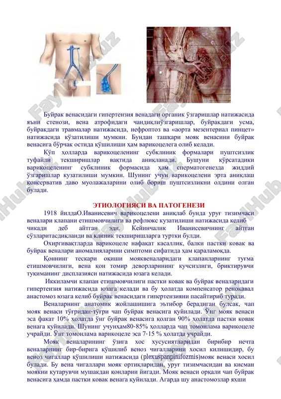 iqlio'zgarishlar, buyrakdagi usma, buyrakdagi travmalar natijasida, nefroptoz va «aorta mezenterial pintset» natijasida ko'zatilishi mumkin. bundan tashqari moyak venasini buyrak venasiga bo'rchak ostida qo'shilishi ham varikotselega olib keladi. ko'p hollarda varikotselening subklinik formalari pushtsizlik tufayli tekshirishlar vaqtida aniqlanadi. bushuni ko'rsatadiki varikotselening subklinik formasida ham spermatogenezda jiddiy o'zgarishlar kuzatilishi mumkin. shuning uchun varikotseleni erta aniqlash qonservativ davo muolajalarini olib borish pushtsizlikni oldini olgan buladi. etiologiyasi va patogenezi 1918 yildao.ivanisevich varikotseleni aniqlab bunda urug' tizimchasi venalari klapani etishmovchiligi va reflyuks kuzatilishi natijasida kelib chikadi deb aytgan edi. keyinchalik ivanisevichning aytgan so'zlaritasdiqlandi va klinik tekshirishlarga turtki buldi. oxirgivaqtlarda varikotsele nafaqat kasallik, balki pastki kovak va buyrak venalari anomaliyalarini simptomi sifatida ham qaralamoqda. qonning teskari oqishi moyakvenalaridagi klapanlarning tug'ma etishmovchiligi, vena qon tomir devorlarining kuchsizligi, briktiruvchi tuqimaning displaziyasi natijasida yuzaga keladi. ikkilamchi klapan etishmovchiligi pastki kovak va buyrak venalaridagi gipertenziya natijasida yuzaga keladi va bu holatda kompensator renokaval anastomoz yuzaga kelib buyrak venasidagi gipertenziyani pasaytirib …