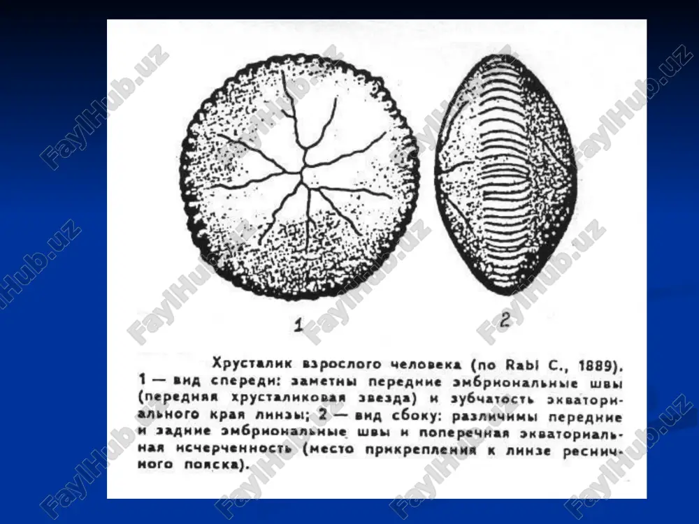 asshiryayushego pod vozdeystviem medriatikov ( sekklyuziya) , diffuzno mutniy xrustalik. lentovidnaya distrofiya v gijney chasti rogovitsi. vtorichnaya katarakta, obrazovavshayasya posle iridotsiklita, protekayushego s virajennoy ekssudatsiey travmatik katarakta povrejdenie kapsuli xrustalika vedet k katarakte.kamernaya vlaga, pronikaya v linzu, vizivaet nabuxanie i pomutnenie xrustalikovix volokon. travmatik katarakta katarakta postranevaya polimorfnaya iiistepeni s soputstvuyushimi izmeneniyami katarakti pri vozdeystvii luchistoy energii. xrustalik chuvstvitelen k vozdeystviyam luchistoy energii, mojet vizvat izmeneniya v xrustalike tolko, esli luchi besprepyatstvenno proxodyat cherez rogovitsu i kamernuyu vlagu i pogloshaetsya veshestvom xrustalika. luchi s razlichnoy dlinoy volni pogloshayutsya sredami glaza po-raznomu: -zona vidimogo spektra (750-300 nm) svobodno pronikayut vnutr glaza. -korotkie volni ultrafioletovoy chasti spektra poglshayutsya, ne doxodya do xrustalika. -luchi s ochen maloy dlinoy volni (rentgenovskie neytroni, radiya ) pronikayut vnutr glaznogo yabloka. pri luchevoy katarakte destruktivniy protsess delyatsya na 5 stadiy 1.v tsentralnix zadnix kortikalnix sloyax xrustalika pomutneniya i poyavlyayutsya vakuoli.ostrata zreniya ne menyaetsya. 2.pomutnennie tochki, razmnojaetsya vakuoli …