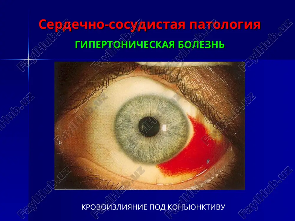 me. serdechno-sosudistaya patologiya ostrie narusheniya krovoobrasheniya sosudov setchatki emboliya tsentralnoy arterii setchatki i ego vetvey serdechno-sosudistaya patologiya ostrie narusheniya krovoobrasheniya sosudov setchatki tromboz tsentralnoy veni setchatki tromboz tsentralnoy veni setchatki (tsvs) voznikaet glavnim obrazom pri gipertonicheskoy bolezni, ateroskleroze, saxarnom diabete, chashe u lits pojilogo vozrasta. u molodix lyudey prichinoy tromboza tsvs mojet bit obshaya (gripp, sepsis, pnevmoniya i dr.) ili fokalnaya (chashe zabolevaniya okolonosovix pazux i zubov) infektsiya. v otlichie ot ostroy neproxodimosti tsas tromboz tsvs razvivaetsya postepenno. bolezni pochek pochechnaya retinopatiya dlya pochechnoy retinopatii xarakterni: uzost sosudov otek setchatki, kotoriy proyavlyaetsya obshim serim fonom rixlie serovatie, razlichnoy formi i velichini vatoobraznie ochagi. pri bolshom chisle oni slivayutsya v sploshnie polya stushevannost granits zritelnogo nerva, ego otek do kartini zastoynogo diska zritelnogo nerva figura zvezdi, sformirovannaya bolee chetkimi (chem vatoobraznie), yarkimi ochajkami vokrug makulyarnoy oblasti, diska zritelnogo nerva krupnie i melkie krovoizliyaniya v setchatku. ix narastanie yavlyaetsya ploxim prognosticheskim priznakom …