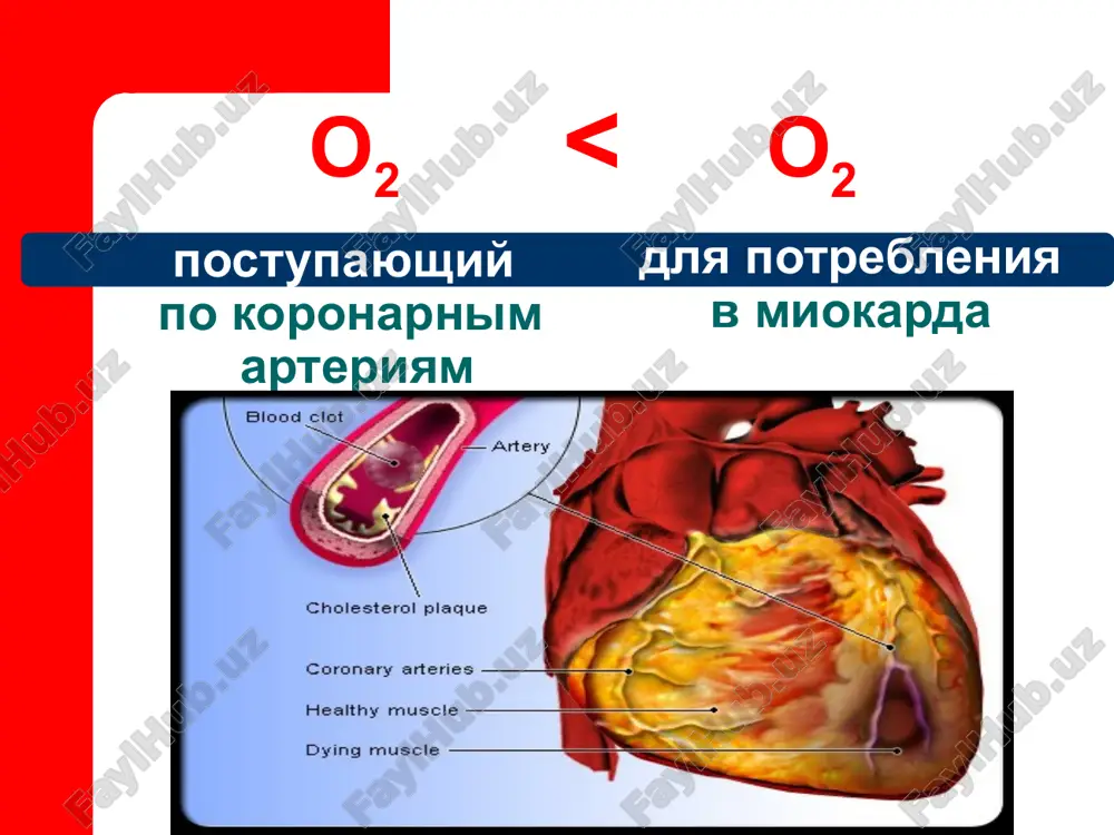 50-100 ed v chas vnutrivenno; sutochnaya doza do 25000 ed; lechenie nfg do 2 nedel; nefraktsionirovanniy geparin (nfg) pokazan vsem bolnim, kotorim provoditsya revaskulyarizatsiya miokarda kontrol achtv ili vremya svyortivaniya krovi kajdie 6 chasov lechenie dezagreganti aspirin 100 mg v sutki; klopidogrel/ plaviks 75 mg v sutki; blokatori iib/iiia retseptorov trombotsitov: reopro/ atrostop/ tsinegreglip; blokatori aktivatsii trombotsitov: kongrelor. lechenie nitrati v techenie pervix 42-48 ch s momenta vozniknoveniya im u bolnix s sn; spustya pervie 48 chasov ot nachala im u bolnix s povtornimi pristupami ili zastoem v lyogkix. vnutrivennoe vvedenie pokazano pri otsutstvii gipotenzii i bradikardii lechenie beta-adrenoblokatori pervaya doza vnutrivenno; pokazano bolnim s taxiaritmiyami; s neblagopriyatnim prognozom techeniya im; soxranyayushiesya ili povtorno voznikshie pristupi; metoprolol, propranolol, atenolol. vsem bolnim v pervie 12 chasov s nachala im lechenie ingibitori apf pokazano bolnim so snijennoy fraktsiey vibrosa (<40%); priyom vnutr s malix razovix doz; polnaya rekomenduemaya doza v techenie 24-48 …