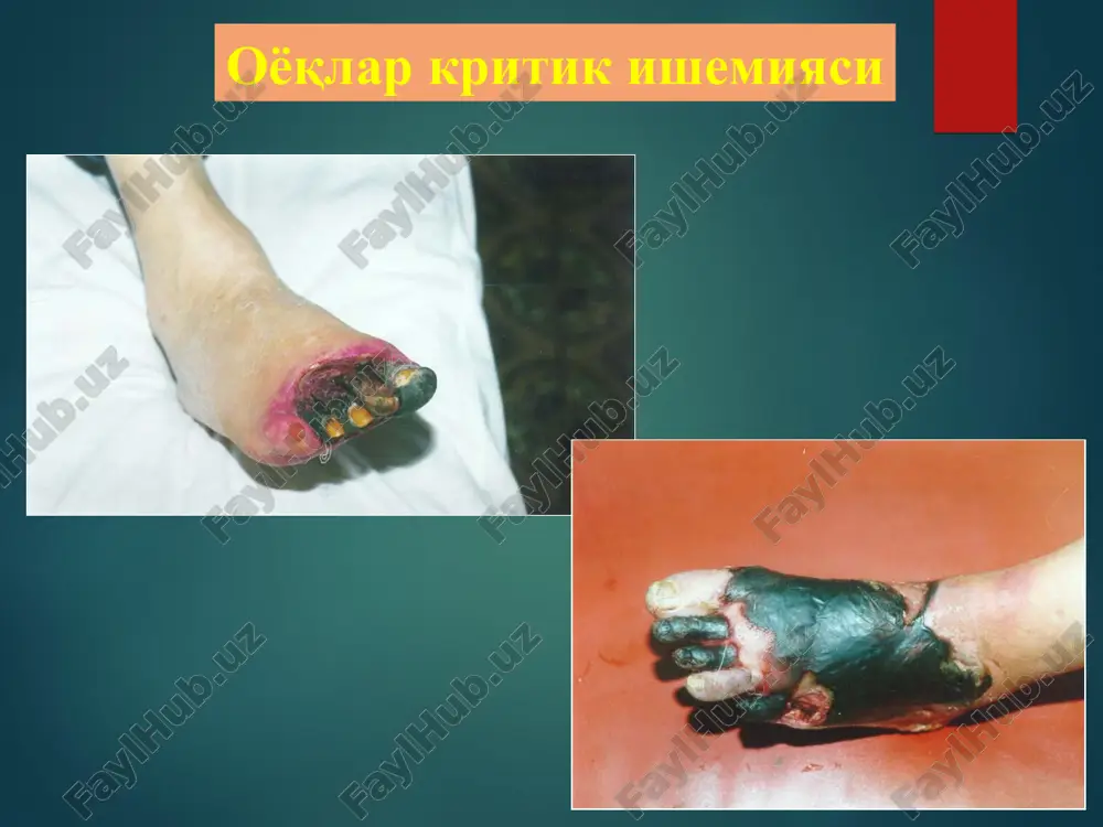 iissiya va zo'rayishisiz. fasliyligi yo'k remiissiya va zo'rayishi vakti bilan. fasl bilan boglik bo'ladi yomon kechishi, fasliylgi yo'k remiissiya va zo'rayishi vakti bilan. fasl bilan boglik bo'ladi asta sekin zo'rayuvchi kechishi, fals bilan boglik emas jaroxat simmetriyasi xar doim emas ko'prok kamdan kam ko'prok simmetrik emas xamrox kasalliklar kb, semizlik, kd, ibs yara kasalligi, nevrasteniya ibs, semizlik, kd – yurak kasalliklari allergik anamnez yo'k bo'lishi mumkin yo'k yo'k yo'k son arteriyasida pulsni yo'kolishi 30% 5% 70-80% puls bor puls bor qiyosiy-diagnostik mezonlar (davomi) belgilar ateroskleroz obliterats. endarteriit tromboz va emboliya reyno kasalligi diabetik panja oyok gangrenasi kuzatiladi kuzatiladi kuzitilishi mumkin kamdan kam kuzatiladi korin aortasida pulsni yo'kolishi 15-20% bemorlarda uchraydi puls bor puls bor puls bor puls bor son arteriyasida sistolik shovkin uchraydi yo'k yo'k yo'k yo'k trofikani buzilishi kuzatiladi kuzatiladi kam kuzatiladi kam kuzatiladi ko'p kuzatiladi oyok panjasini rangi okimtir prekapilyar flebit xisobiga ko'kimtir okimtir, marmarli okimtir giperemiya, yon …