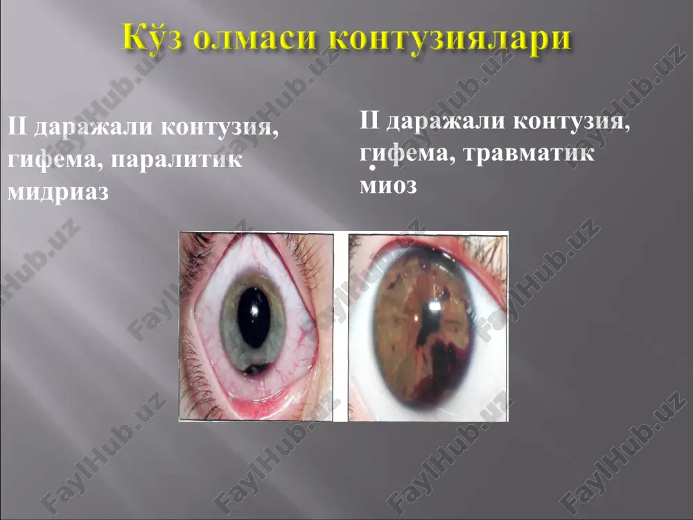 matik kuchishlarni okibati ikkilachi kuchishiga nisbatan ijobiy, ba'zi xolatlarda to'r pardaning o'zi joyiga turishi kuzatiladi. eski to'r pardaning chegarali ko'chishi (makulyar soxani kamrab olgan) amaliyot o'tkazilgan travmatik to'r pardaning ko'chishi . viden val vdavleniya, distalnee kotorogo otsloennaya setchatka davolash chegaralangan to'r pardani ko'chishida lazer koagulyatsiya amaliyotini uzi etarli bo'ladi boshka turdagi ko'chilarda xirurgik davolash – plombalash, tsirklyaj, endolazerkoagulyatsiyaning endovitreal usullaridan foydalaniladi. asoratlar kuruv a'zosida jaroxat o'tkazgan, ko'z ichiga qon quyilishlar, ko'z ichi yot jismlarini diaskleral usul bilan olib tashlanganda yoki kontuziyalar natijasida gemoftalm, ekssudativ xorioretinit kuzatilagan bemorlarda - proliferatsiyalangan retinit asorati kuzatilishi mumkin. preretinal proliferatsiya, ko'z olmasi kontuziyasi natijasidap to'r parda distrofiyasi xorioideyaning yirtilishi, qisman gemoftalm, neyropatiya xorioideyaning yirtilishi, intraretinal qon quyilish, krovoizliyaniya, qisman gemoftalm xorioideyaning kup sonli yirtilishlari, intraretinal va makulyar qon quyilish makula orqali xorioideyaning yirtilishi, intraretinal qon quyilish mnojestvennie razrivi sosudistoy v isxode tyajeloy kontuzii glaza chastichniy razriv sosudistoy v makulyarnoy i peripapillyarnoy oblasti v-skanogramma. ko'z olmasi …