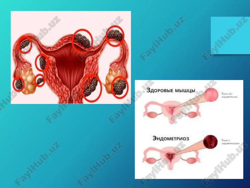 endometrioz. klinikasi. tashxis. davolash - Page 3