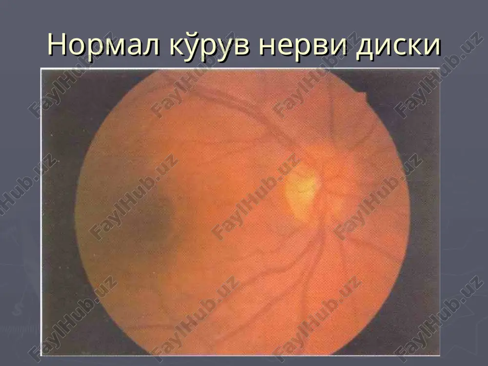 ko'z yorig'ining berkilmasligi natijasida rivojlanadi. bir tomonlama va ikki tomonlama bo'ladi. belgilari: 1. ko'rish o'tkirligi pasaygan bo'ladi. 2. k.n.h. bir oz pastda oq rangli chegarasi aniq kosasimon ekskavatsiya yuzaga keladi. 3. k.n.h. kattalashib prepapilyar soxada pigment o'zgarishlari bo'lishi yoki bo'lmasligi mumkin. 4. to'r parda qon tomirlarida patologik o'zgarishlar bo'lmaydi. markazida ekskavattsiyasi kichik bulgan disk markazida ekskavattsiyasi kattaroq va chuqurroq bo'lgan disk aniq chegarali oq yassi disk diskdan o'tuvchi qon tomirlarning kamayishi prepapilyar qon tomirlarning ingichkalashishi. noanikqchegarali biroz bo'rtib turuvchi oq rangli disk ko'ruv nervi diskidan o'tuvchi qon tomirlar sonining kamayishi bu anevrizma odatda qorachiq shikastlanishi bilan birga birdaniga boshlangan og'riqli iii nerv falaji bilan namoyon bo'ladi. e'tiboringiz uchun raxmat!