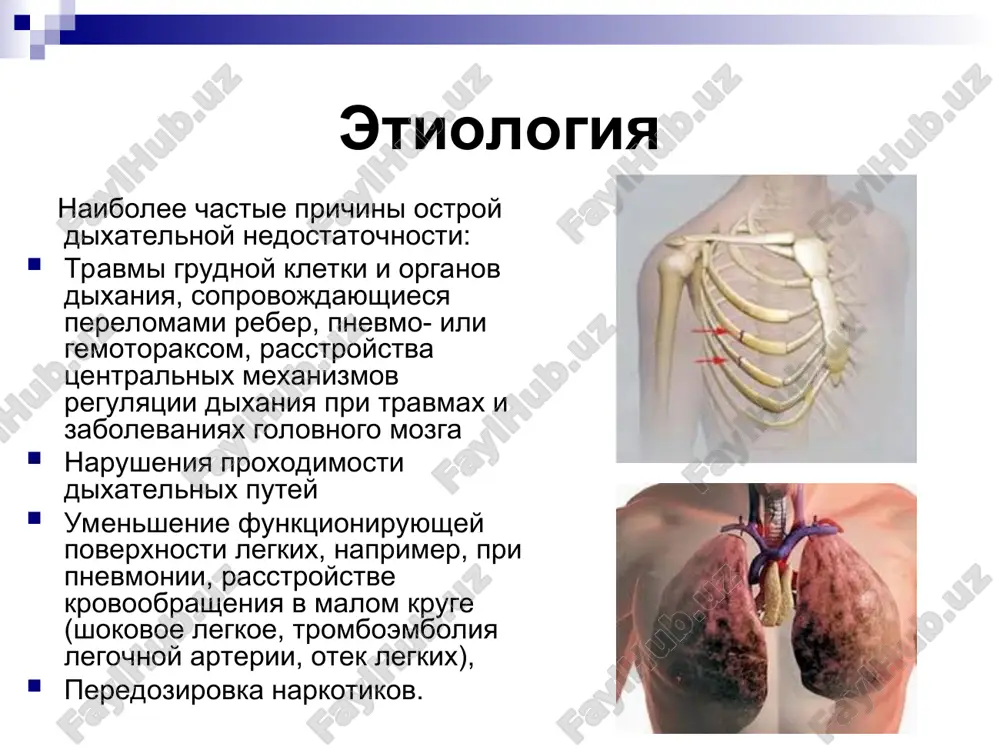 a. giperkapniya giperkapníya — eto sostoyanie, vizvannoe izbitochnim kolichestvom co2 v krovi; otravlenie uglekislim gazom. yavlyaetsya chastnim sluchaem gipoksii. pri kontsentratsii so2 v vozduxe bolee 5 % ego vdixanie vizivaet simptomi, ukazivayushie na otravlenie organizma: golovnaya bol, toshnota, chastoe poverxnostnoe dixanie, usilennoe potootdelenie i daje poterya soznaniya. klinicheskaya fiziologiya gipoksii i giperkapnii sushestvuet traditsionnoe delenie gipoksii na pyat form: legochnuyu (gipoksicheskuyu, ili dixatelnuyu) tsirkulyatornuyu gemicheskuyu gistotoksicheskuyu (tkanevuyu) i smeshannuyu legochnaya gipoksiya nablyudaetsya pri nedostatochnom postuplenii kisloroda v krov legochnix kapillyarov. tsirkulyatornaya gipoksiya voznikaet pri narushenii transporta kisloroda k tka-nyam iz-za rasstroystv krovoobrasheniya. gemicheskaya gipoksiya — eto rezultat nesostoyatelnosti krovi kak gazotrans-portiruyushey sredi. gistotoksicheskaya gipoksiya (dizoksiya) — nesposobnost tkaney usvoit postupa-yushiy k nim kislorod — voznikaet pri porajenii fermentativnix protsessov. smeshannaya forma gipoksii, vidimo, naibolee chastaya. daje esli pervichnaya gi-poksiya bila legochnoy, to ee fiziologicheskie effekti privodyat k tsirkulyatornoy gipoksii, poskolku voznikaet arteriolospazm i narushenie reologii krovi. klinika priznaki odn: odishka …