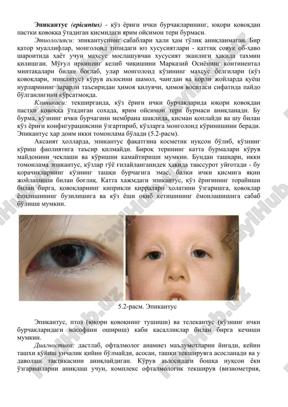 osi faoliyatlarini kuzatish. oftalmolog tomonidan o'z vaqtida nazoratda bo'lish va asoratlarni oldini olish bo'yicha tushuntirish ishlarini olib borish. ptozda, ambliopiya va g'ilaylikni oldini olish uchun, operatsiyadan oldingi choralar – bu uyg'oq paytda yuqori qovoqni (yoki ikkala qovoqni) ko'tarishdan iboratdir. yopishqoq tasmasining (leykoplpstir) bir uchi yuqori qovoq chetiga, ikkinchisi esa qovog'i ko'tarilgan holatda, qosh ustiga yopishtiriladi. qovoqlar ochib-yopilganda, deyarli, to'liq yopish mumkin bo'lgan darajagacha ko'tariladi. uyqu paytida, terining shilinishini oldini olish uchun, yopishqoq tasmani olib tashlash kerak. stomatolog-shifokorning taktikasi: ushbu nuqson aniqlanganda, to'liq tekshiruv va keyingi tavsiyalarni olish uchun, oftalmologga yo'llanma berish kerak. ko'ruv a'zosi faoliyatlarini kuzatish. o'z vaqtida kuzatuv va asoratlarni oldini olish uchun, oftalmolog nazoratida turish kerakligi bo'yicha tushuntirish ishlarini olib borish. epikantus (epicantus) - ko'z yorig'i ichki burchaklarining, yuqori qovoqdan pastki qovoqqa o'tadigan qismidagi yarim oysimon teri burmasi. etiologiyasi: epikantusning sabablari hali ham to'liq aniqlanmagan. bir qator mualliflar, mongoloid tipidagi yuz xususiyatlari - qattiq sovuq ob-havo sharoitida hayot …
